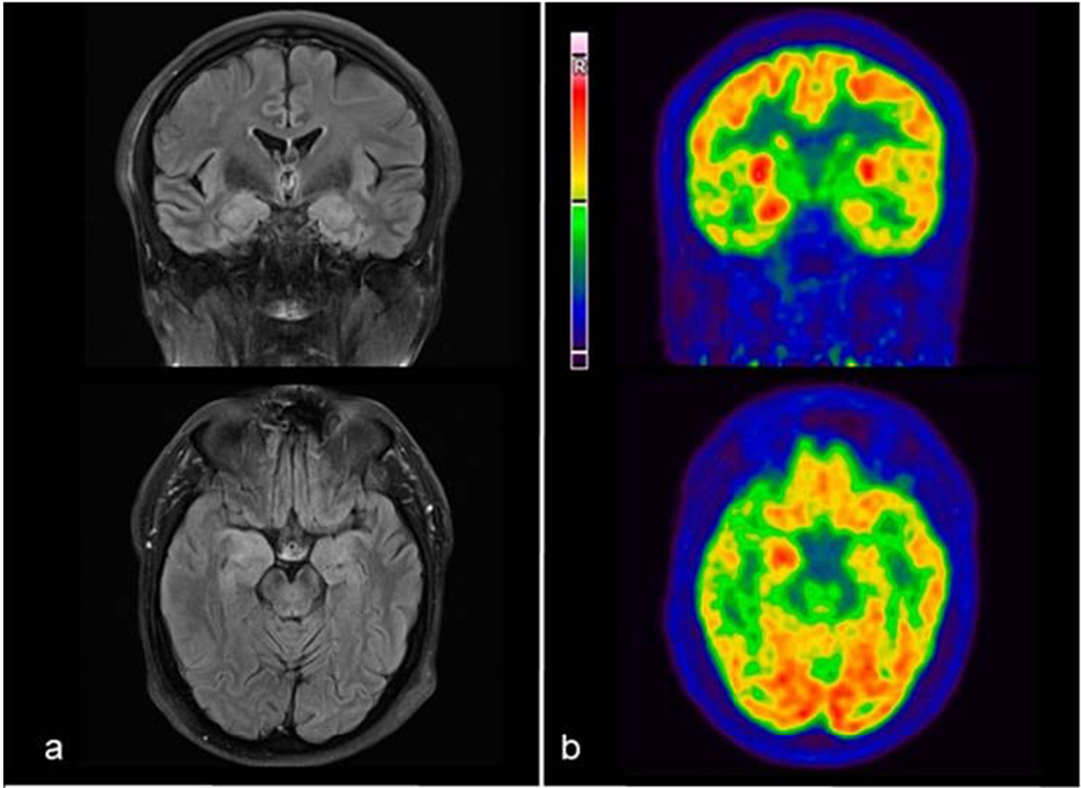 Autoimmune Limbic Encephalitis: A Review Of Clinicoradiological ...