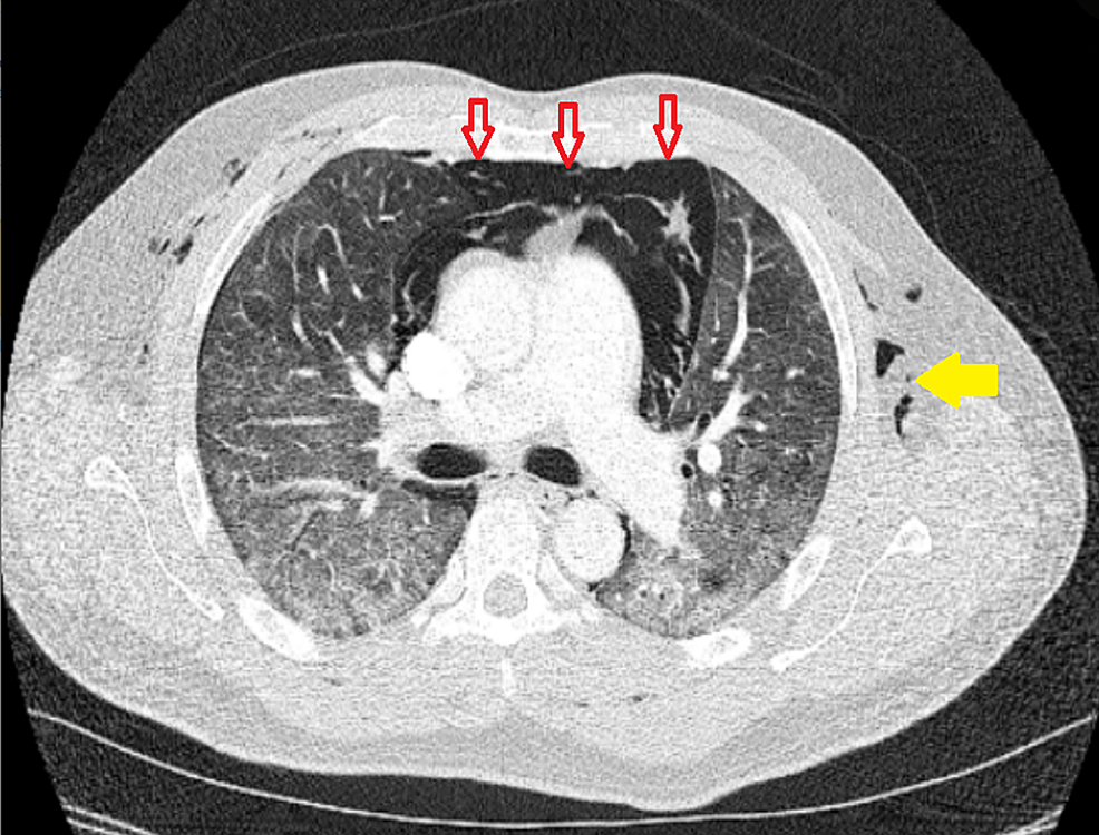 Cureus The Macklin Effect in COVID19