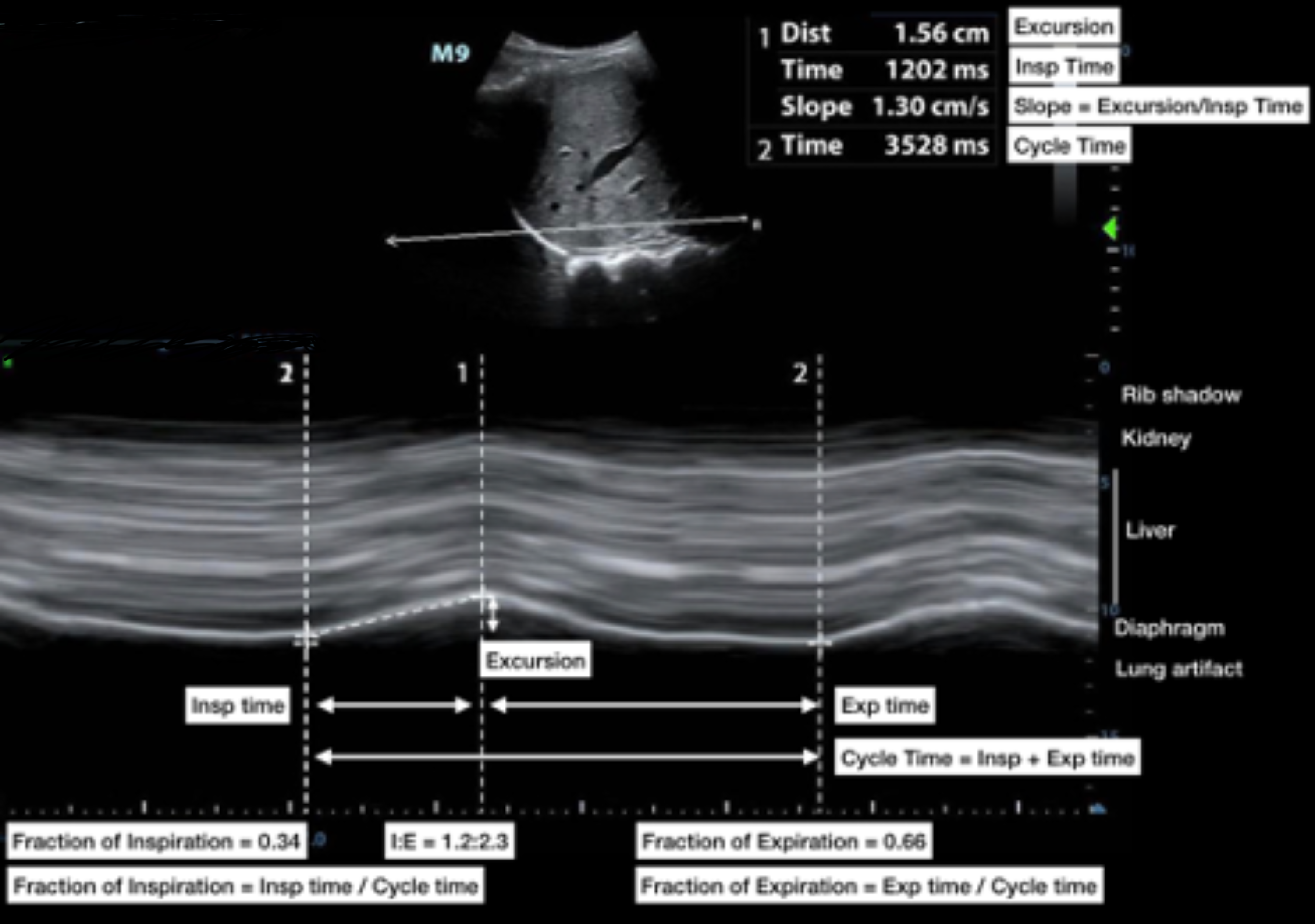 Cureus The Use of AngleIndependent MMode in the Evaluation of