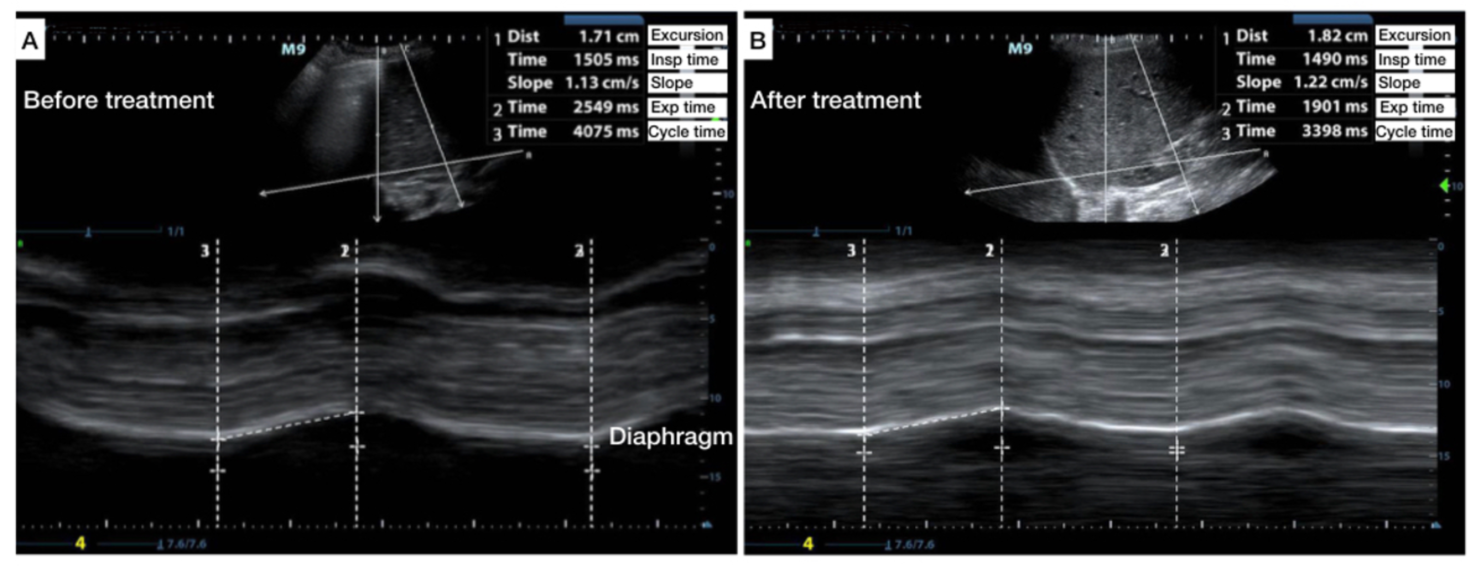 Cureus The Use of AngleIndependent MMode in the Evaluation of