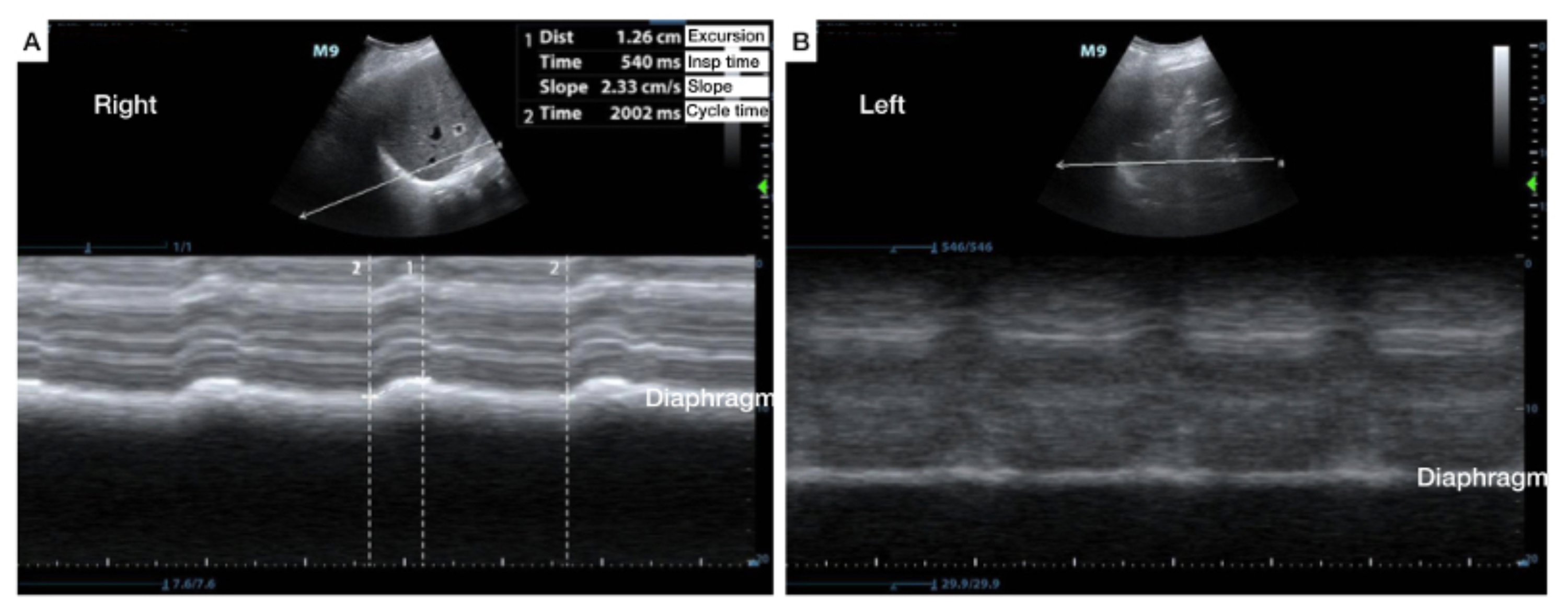 Cureus The Use of AngleIndependent MMode in the Evaluation of