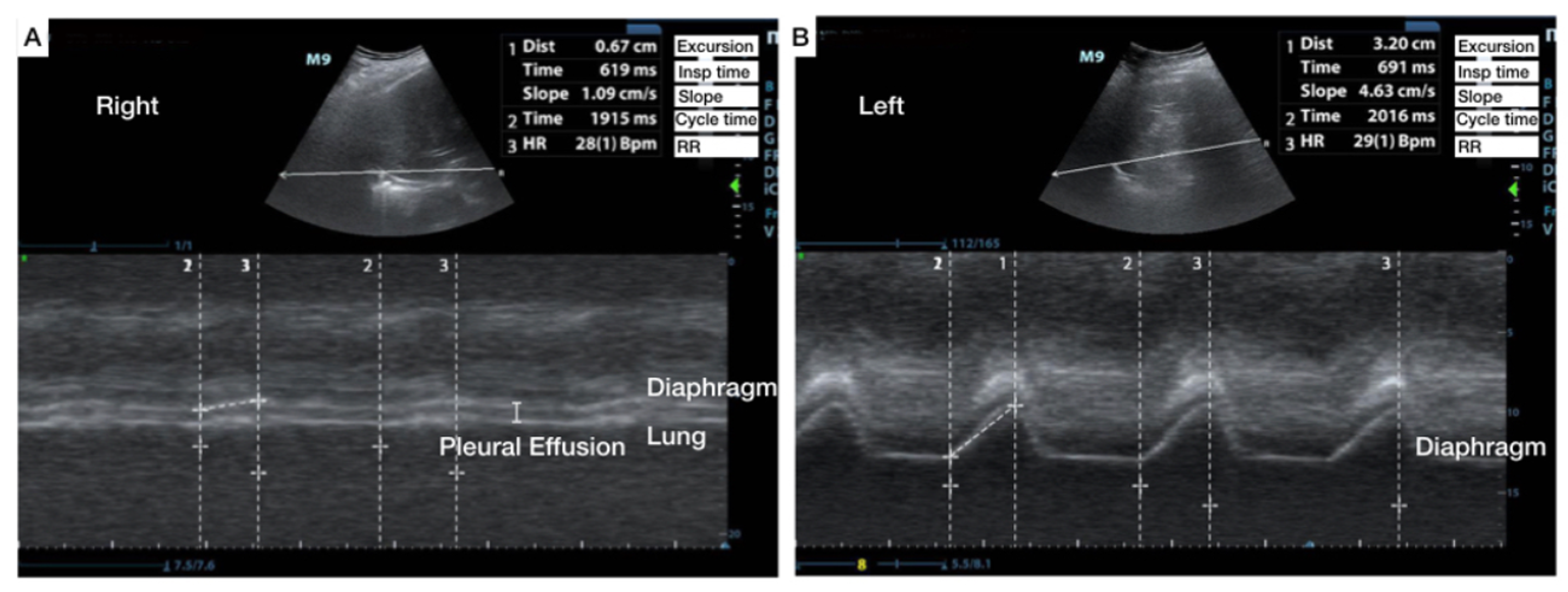Cureus The Use of AngleIndependent MMode in the Evaluation of