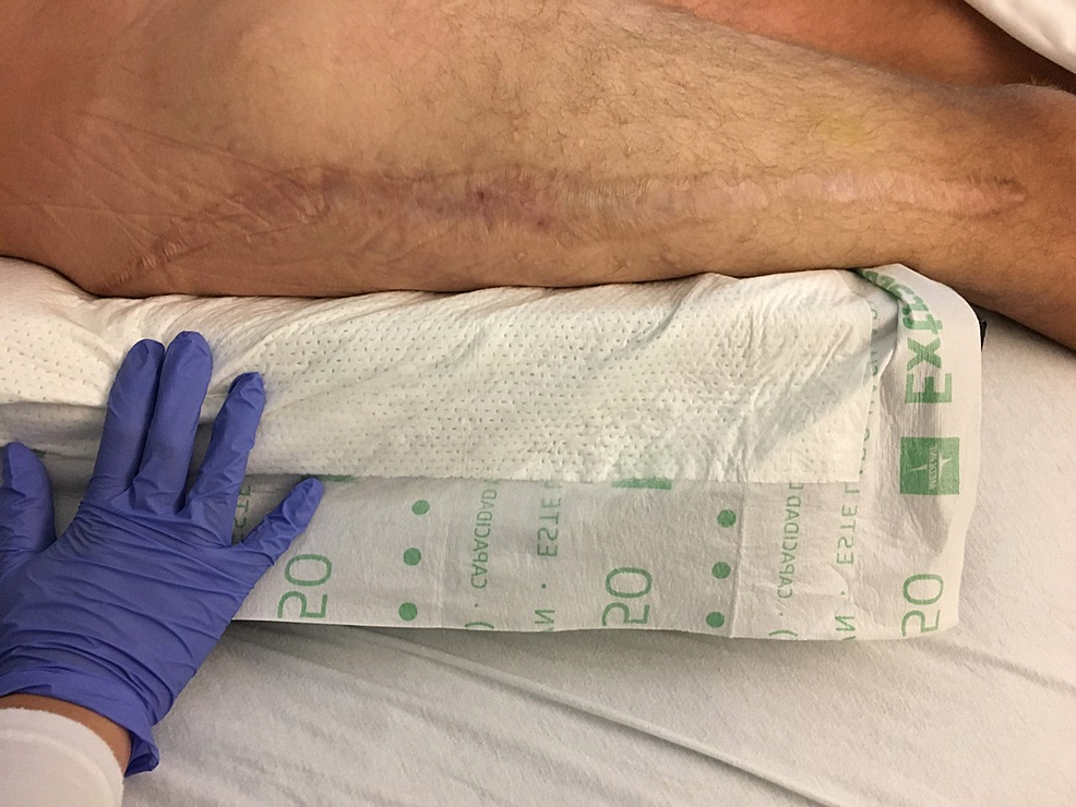 Gluteal Compartment Syndrome