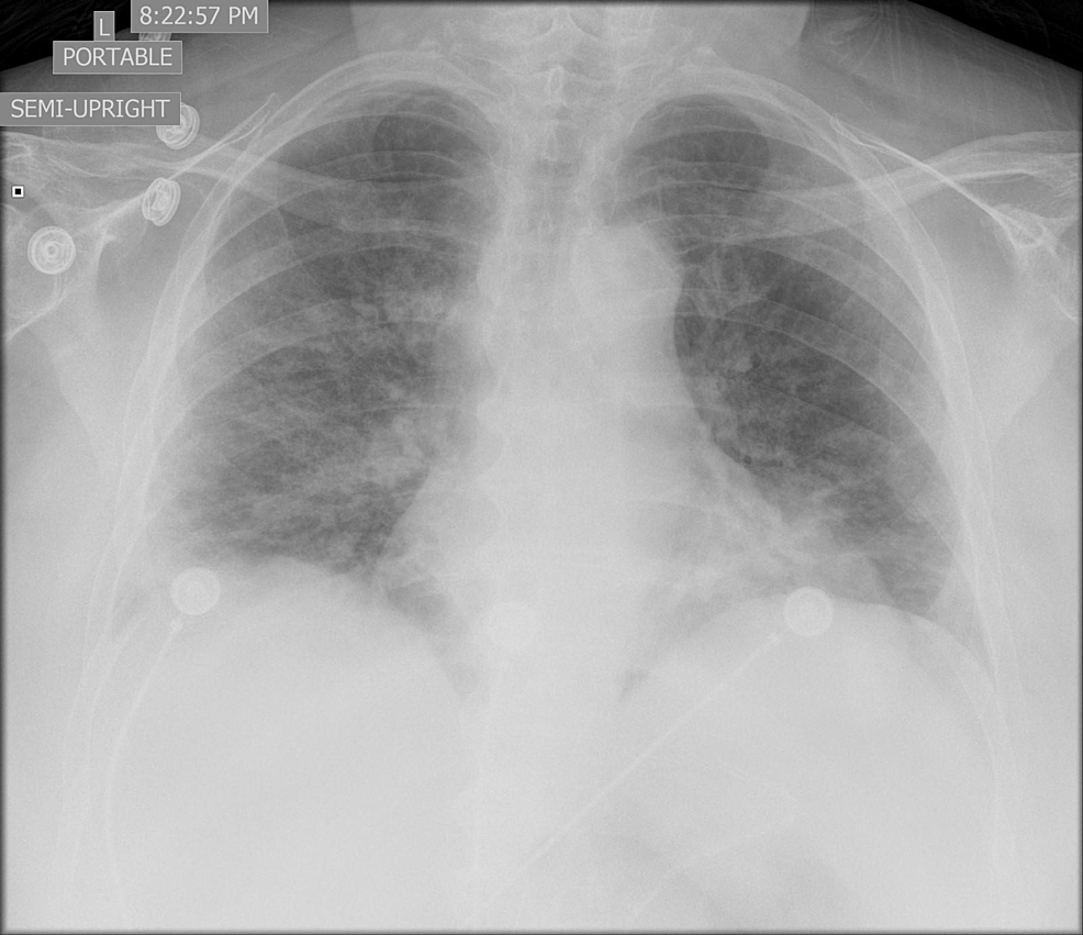 Chest-x-ray-which-showed-bilateral-diffuse-consolidation-consistent-with-multifocal-pneumonia 