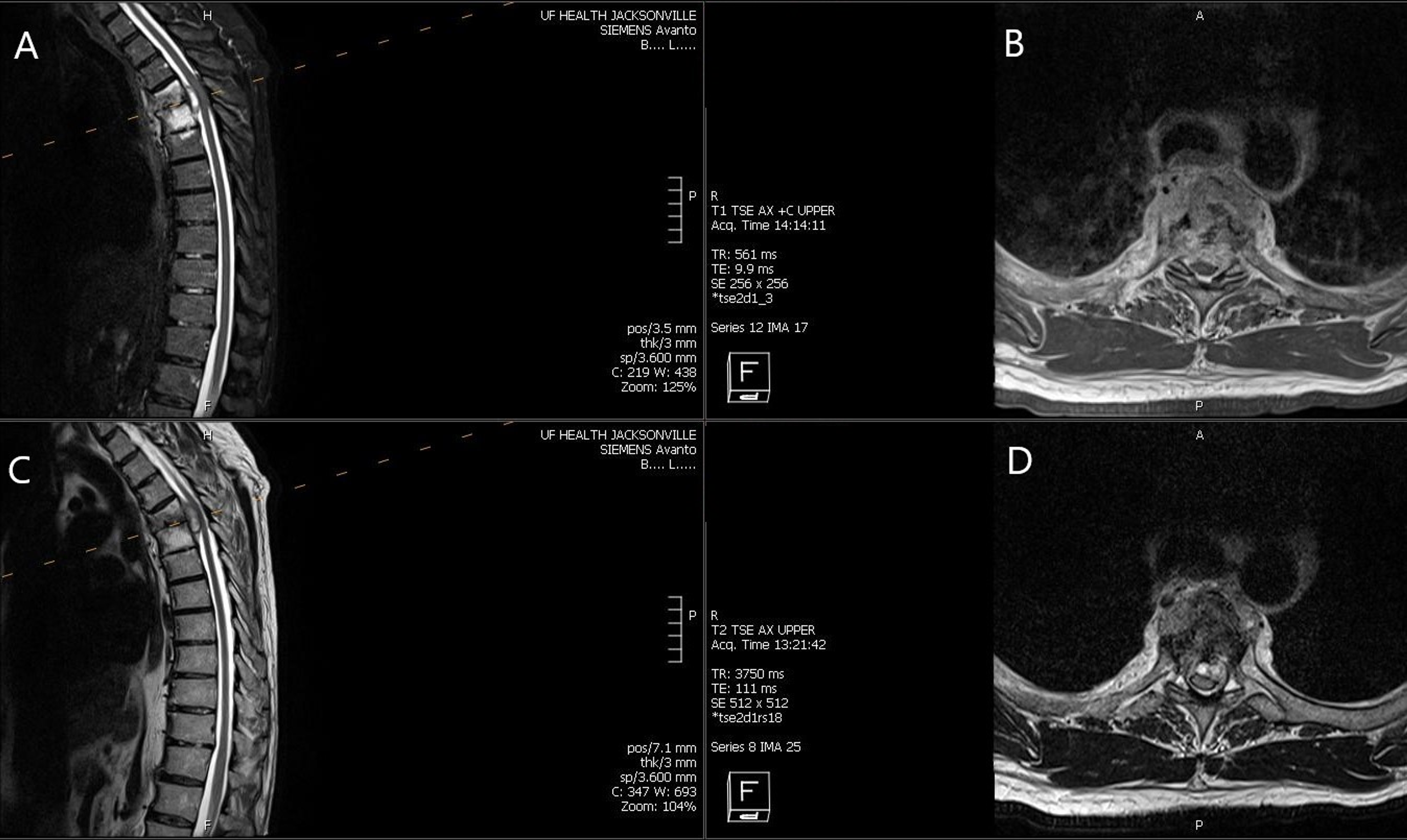 Cureus Spinal Tuberculosis Secondary To Intravesical Bacille Calmette Guerin Treatment For Bladder Cancer