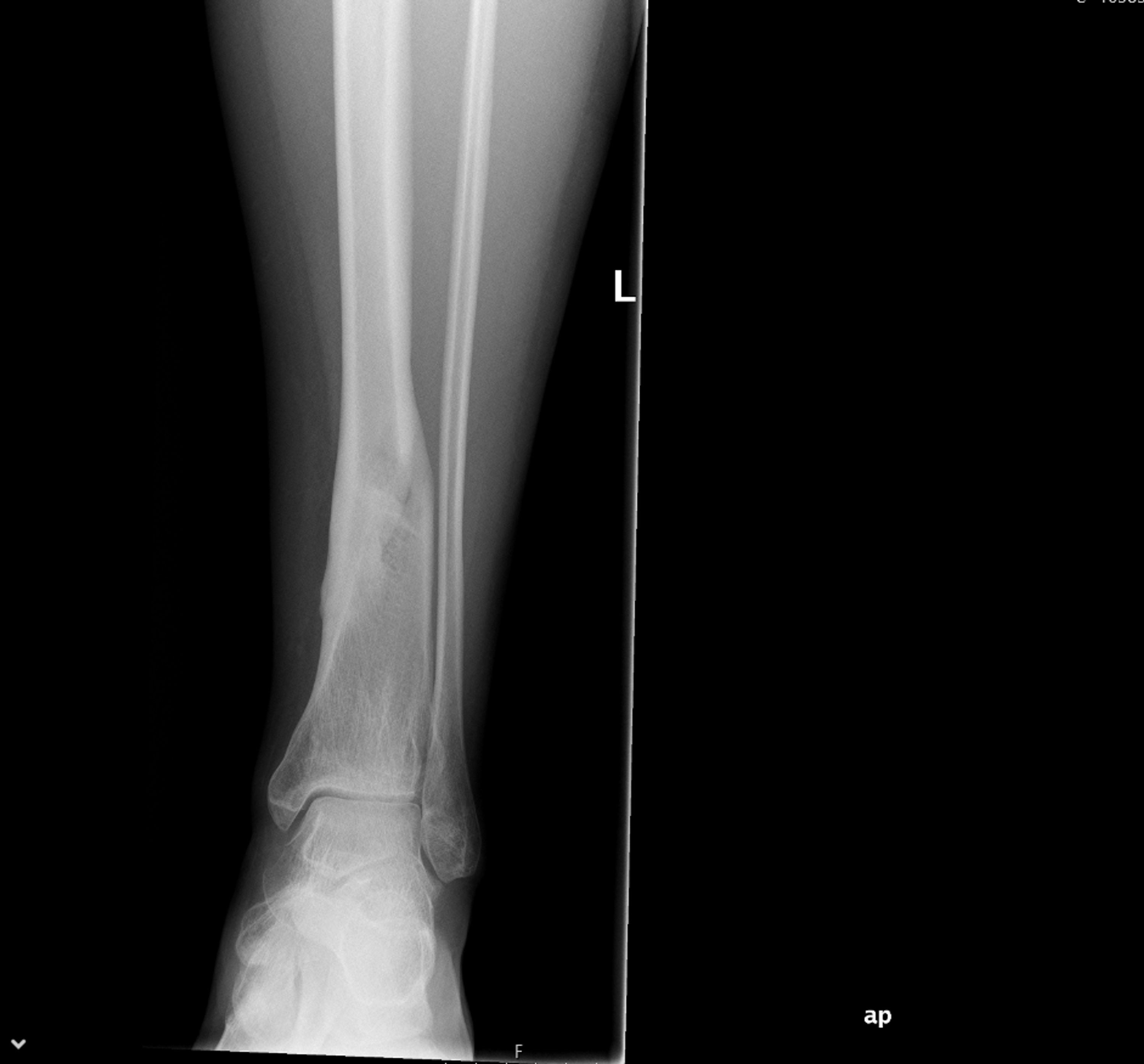 Cureus Fracture Nonunions and Delayed Unions Treated With Low