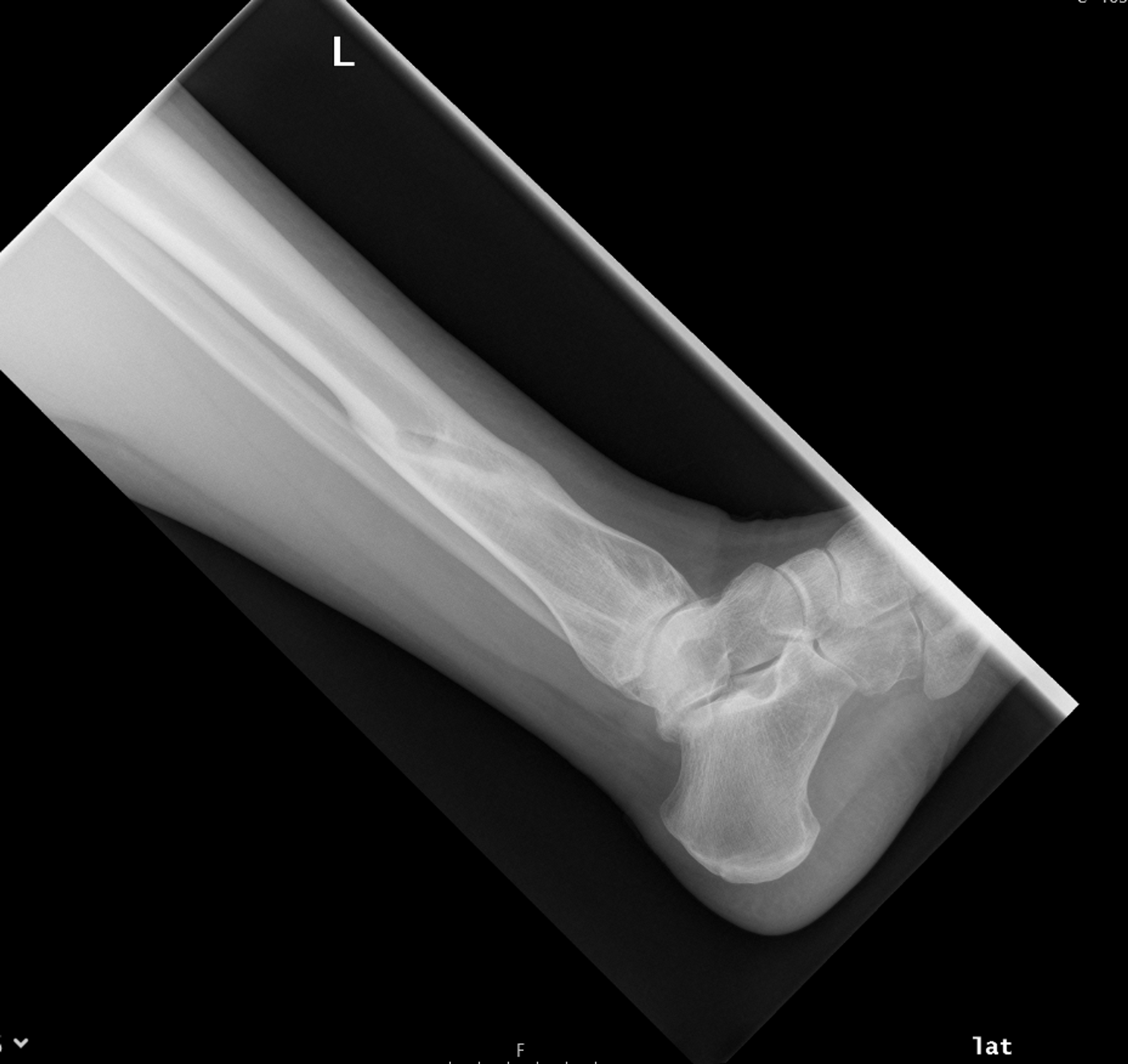 Cureus Fracture Nonunions and Delayed Unions Treated With Low