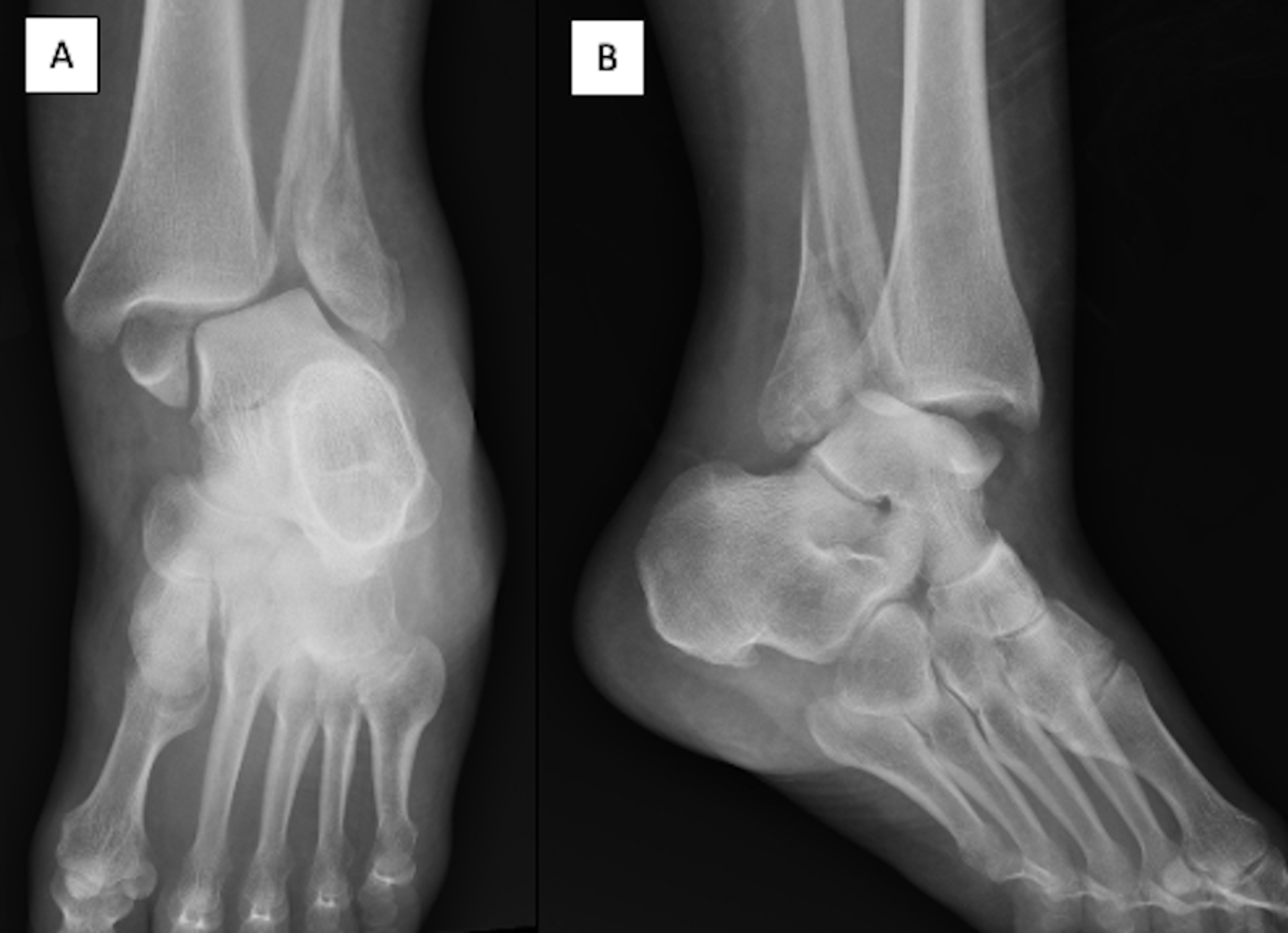 Cureus Rotational Ankle Fracture Dislocation With Associated Lisfranc