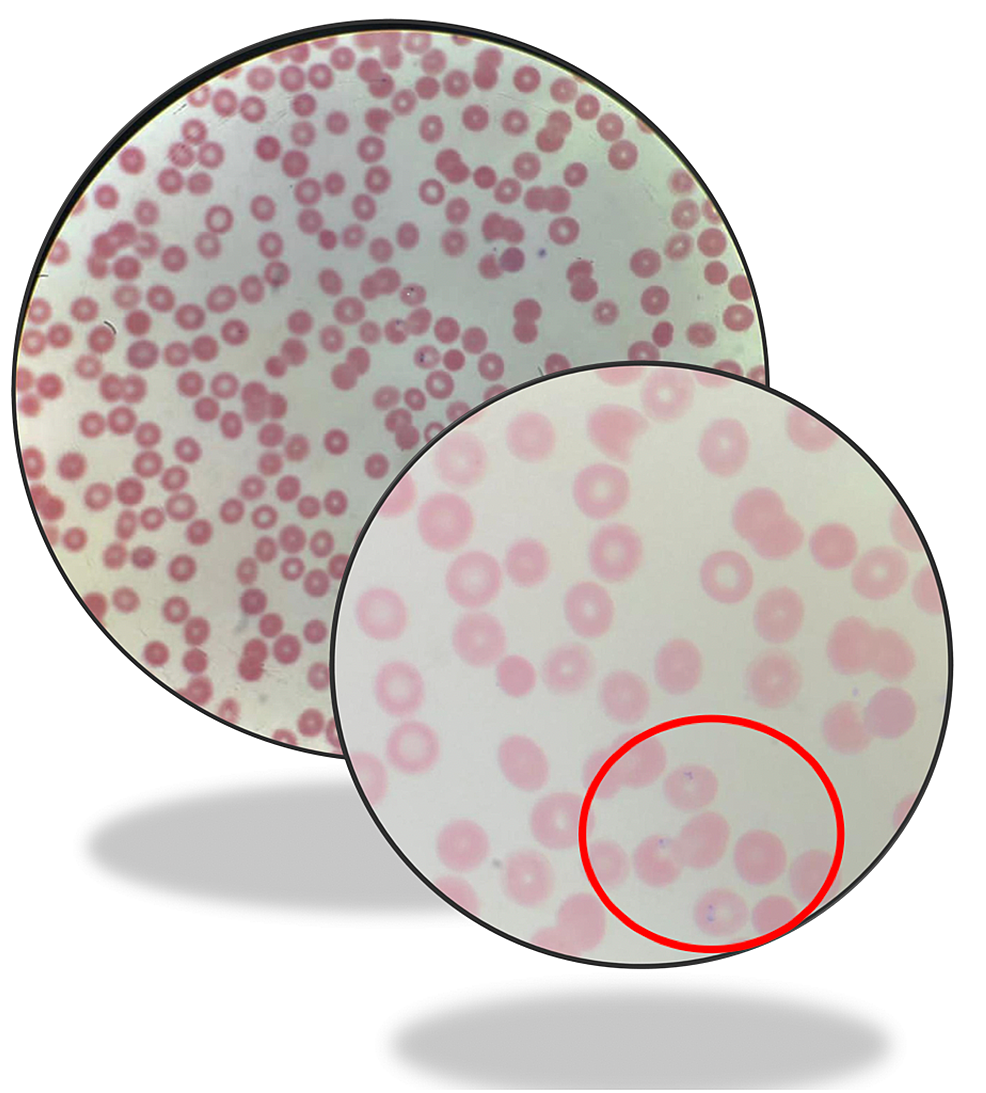 Cureus A Case of Tick Bite Induced Babesiosis With Lyme Disease