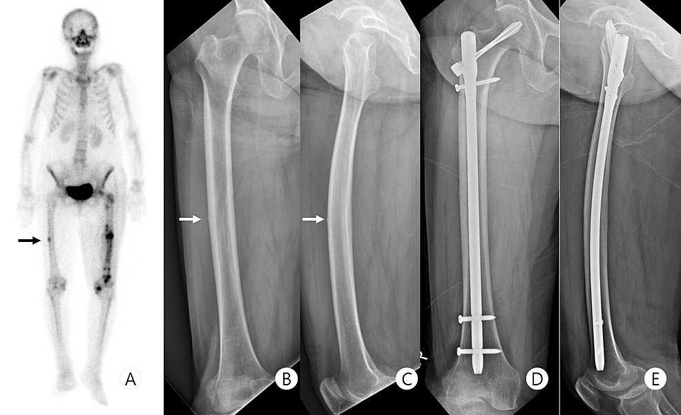 Effect of fragmentary displacement and morphology in the treatment of  comminuted femoral shaft fractures with an intramedullary nail. | Semantic  Scholar