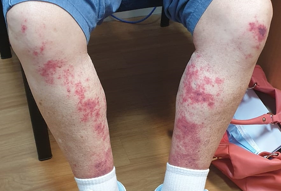 Cureus Leukocytoclastic Vasculitis In A Patient With Rheumatoid Arthritis