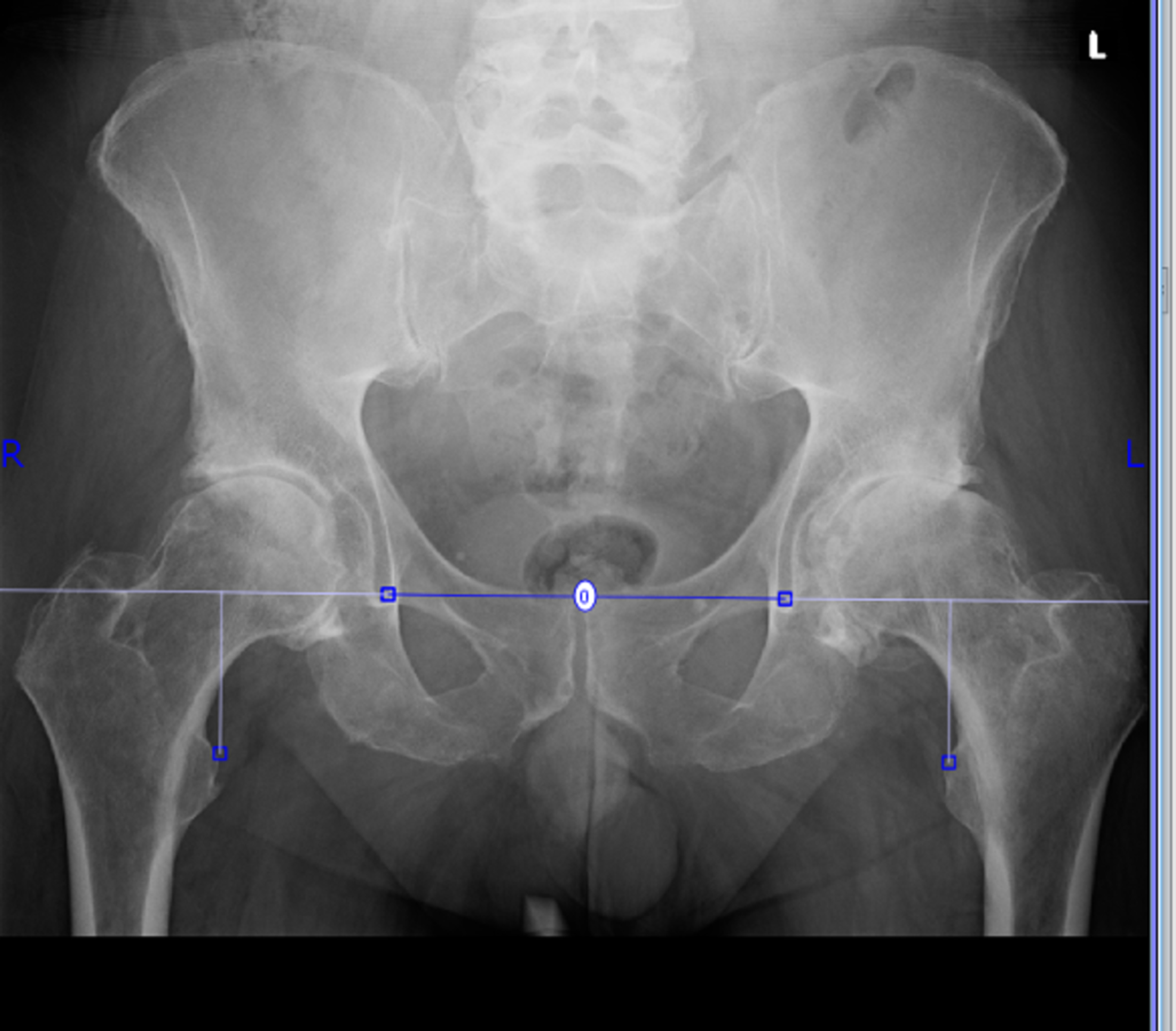 Cureus | Limb Length Inequality in Patients After Primary Total Hip ...