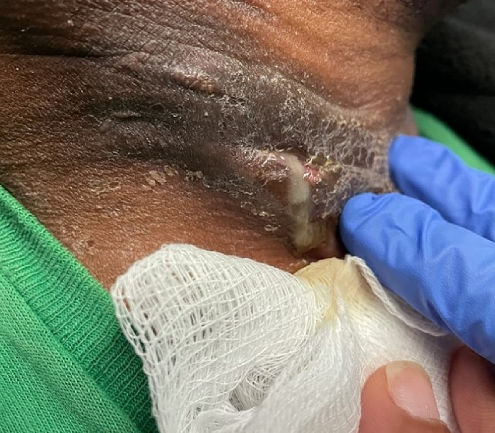 Cureus Hidradenitis Suppurativa at an Site A Review of Its