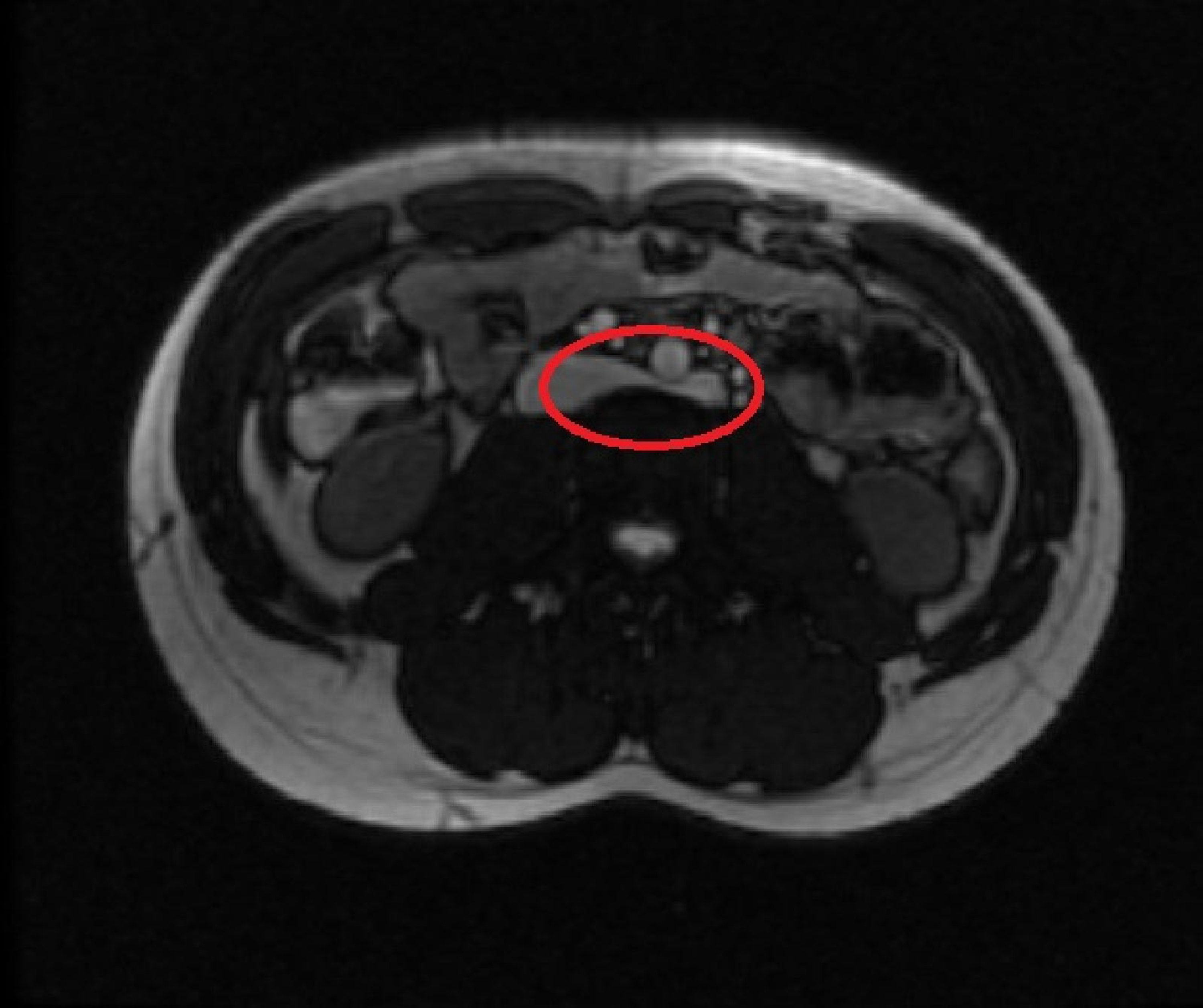 Cureus Atypical Posterior Nutcracker Syndrome in a 17YearOld Male