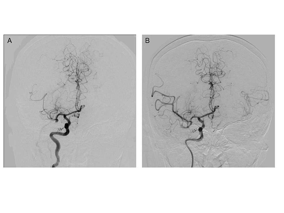 Pre-and-postoperative-angiography.