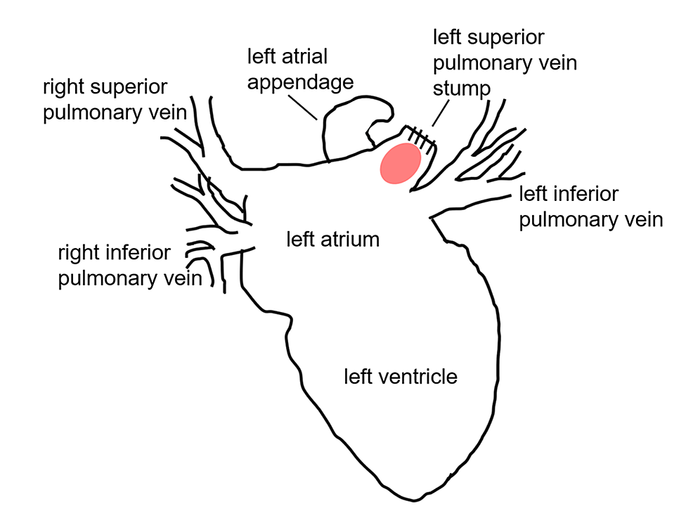 Schema-of-the-left-atrium,-left-atrial-appendage-(LAA),-and-the-pulmonary-vein-(PV)-stump.-