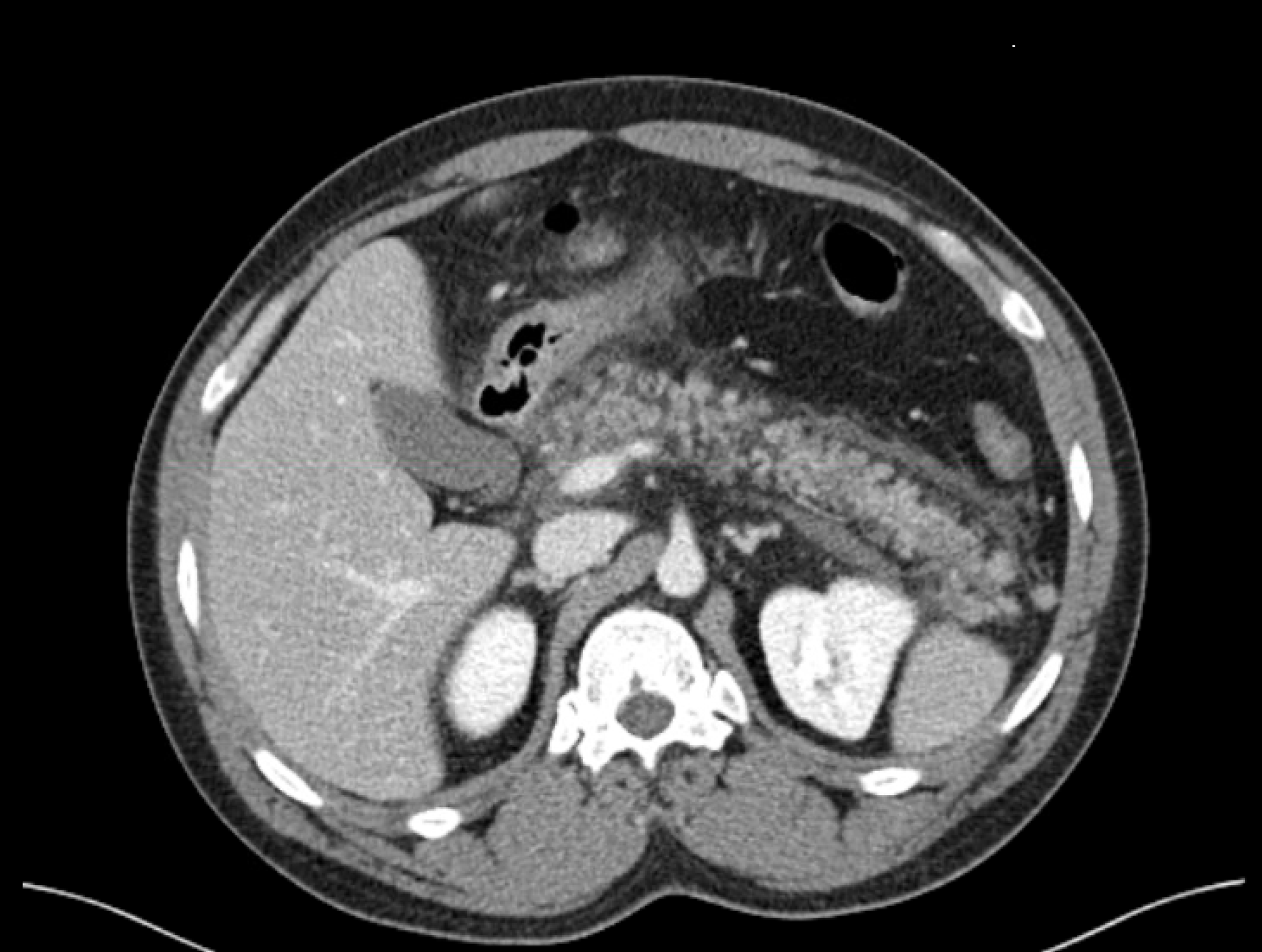 Cureus Covid 19 Necrotizing Pancreatitis And Abdominal Compartment