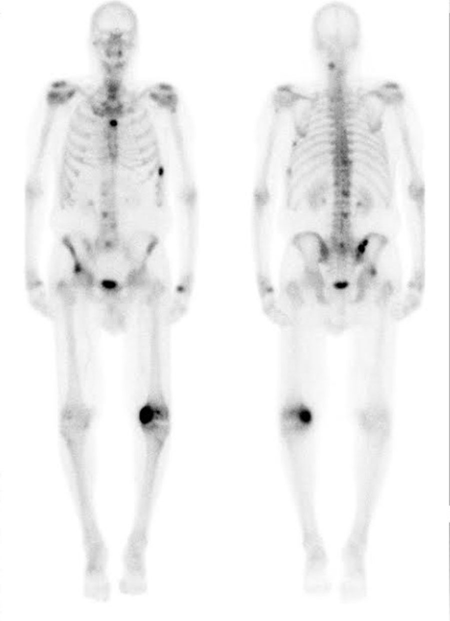 Cureus | An Unusual MRI Appearance of Osseous Metastases