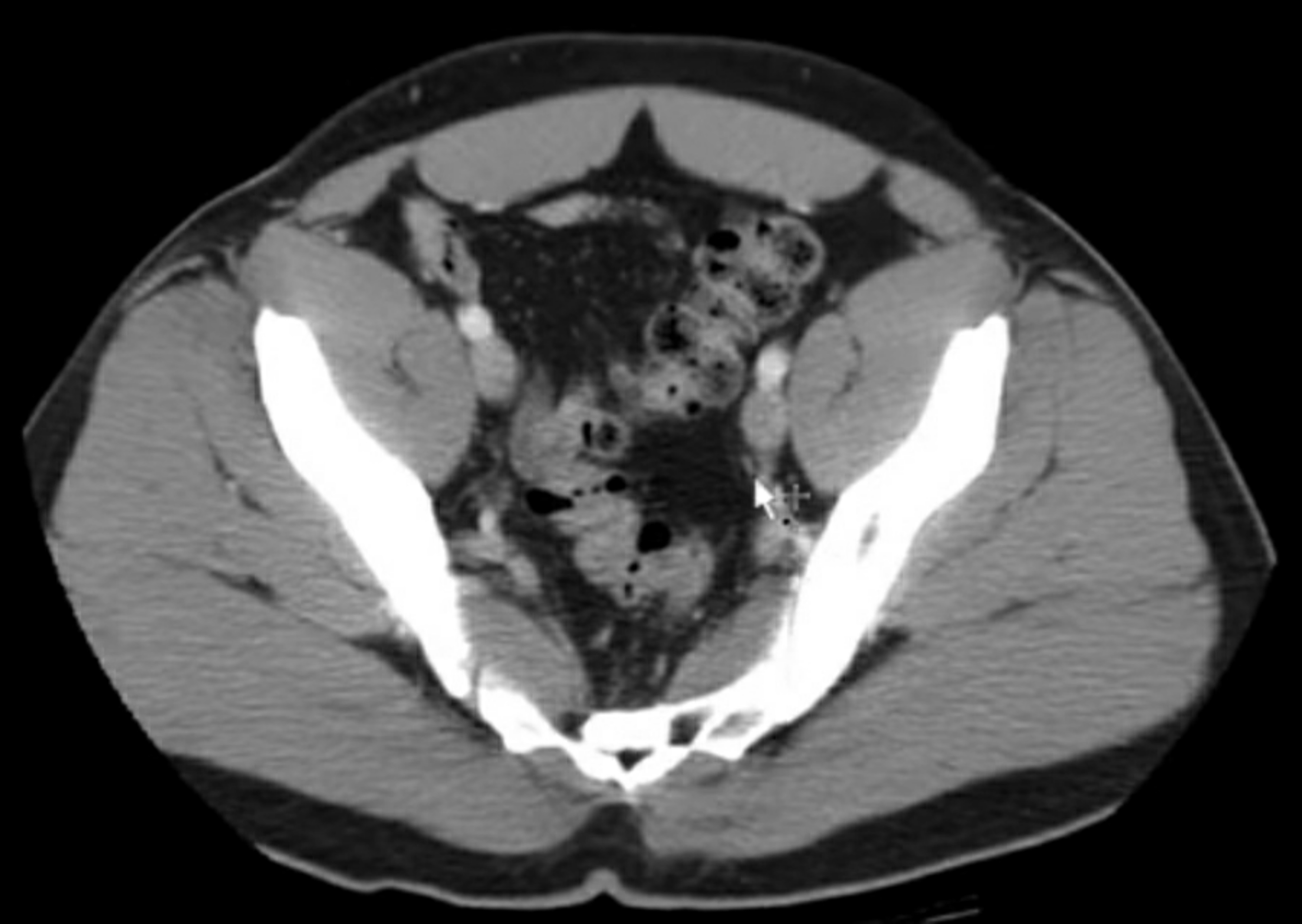 Cureus Spindle Cell Carcinoma of Colon Presenting as