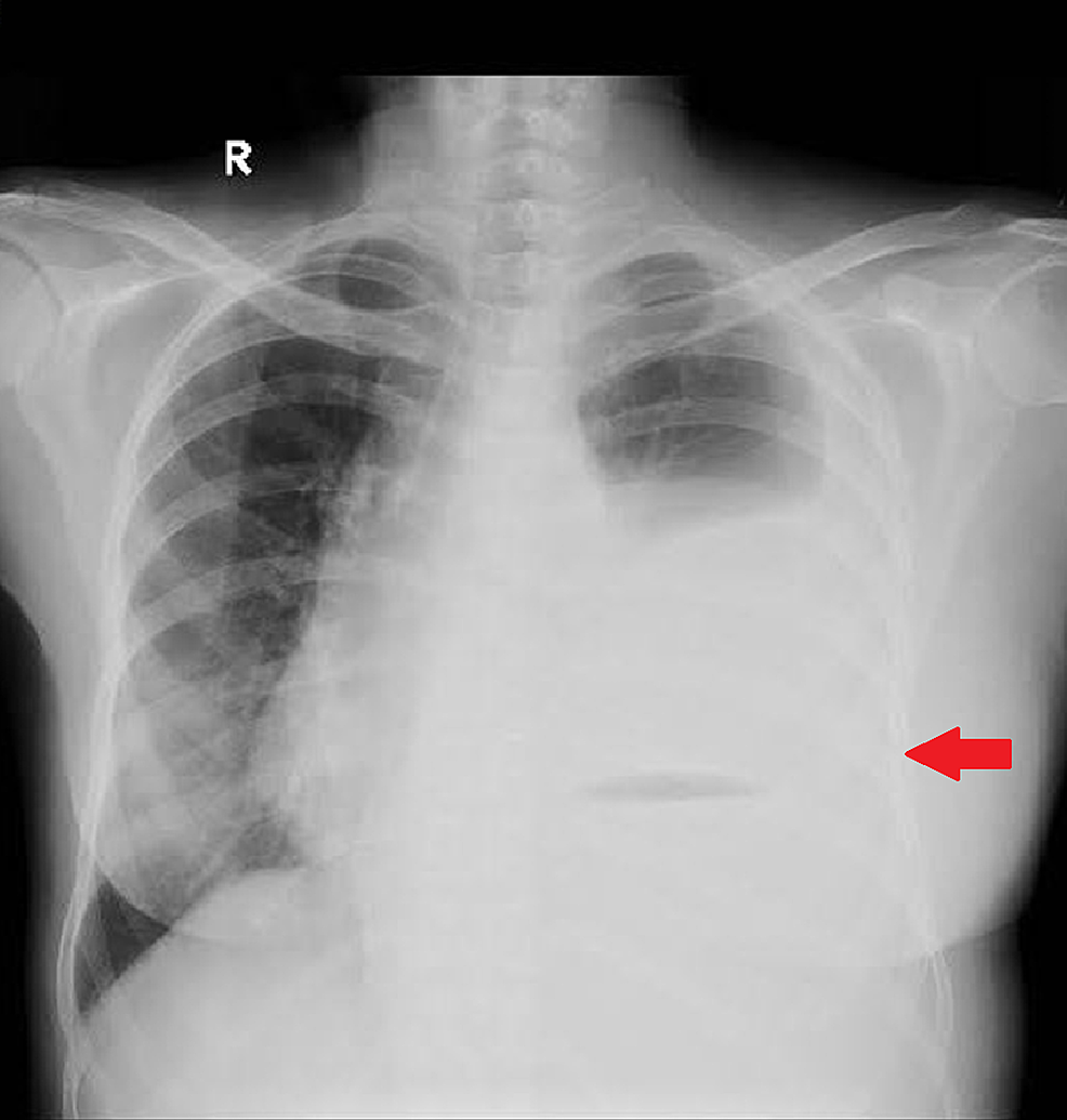 Severe Iron Deficiency Anemia Leading to Thrombocytosis With Arterial