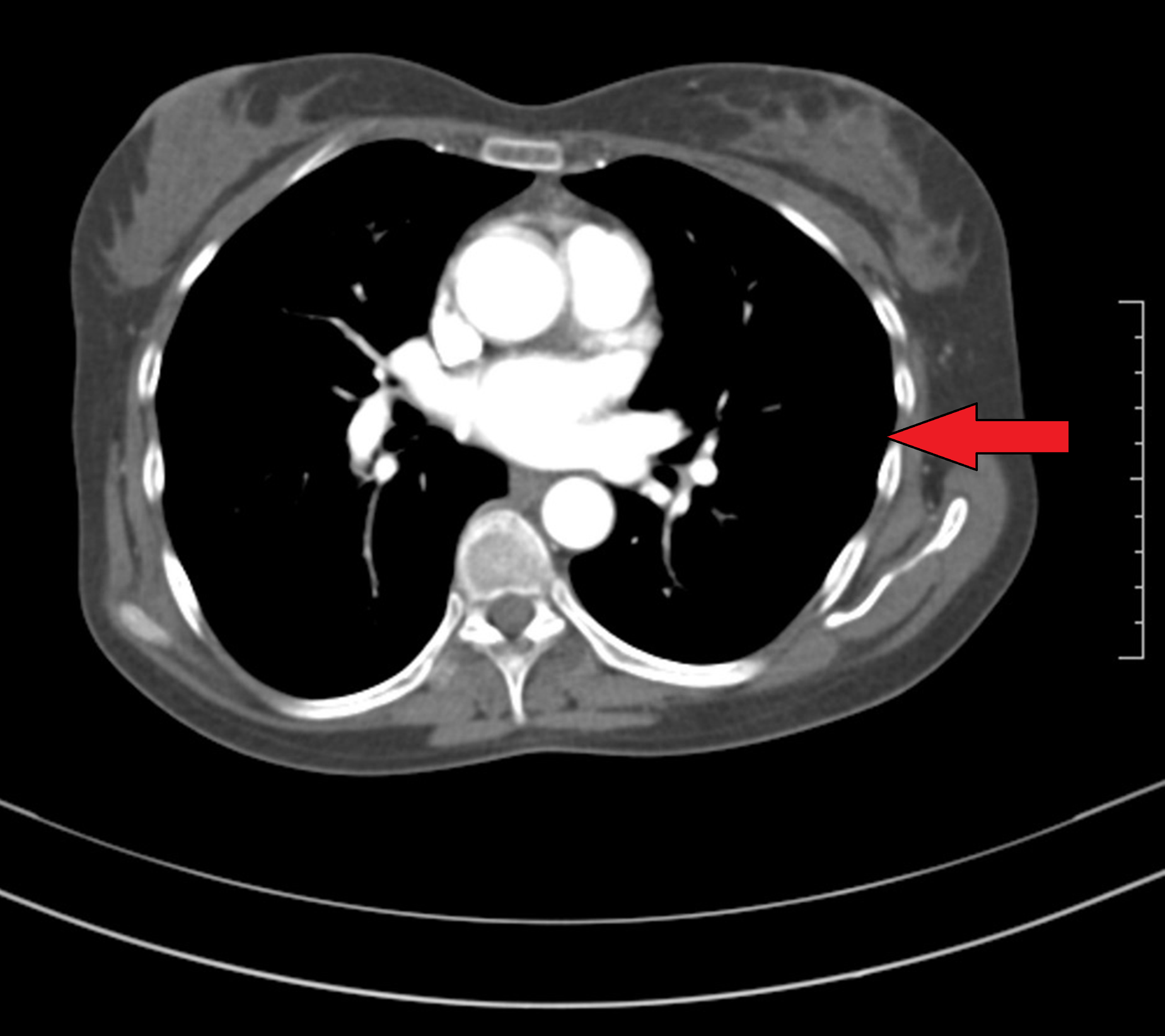 Severe Iron Deficiency Anemia Leading to Thrombocytosis With Arterial