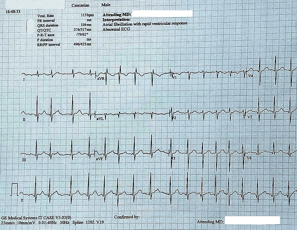 The-initial-electrocardiogram-showing-atrial-fibrillation-with-a-rapid-ventricular---response-and-repolarization-abnormalities