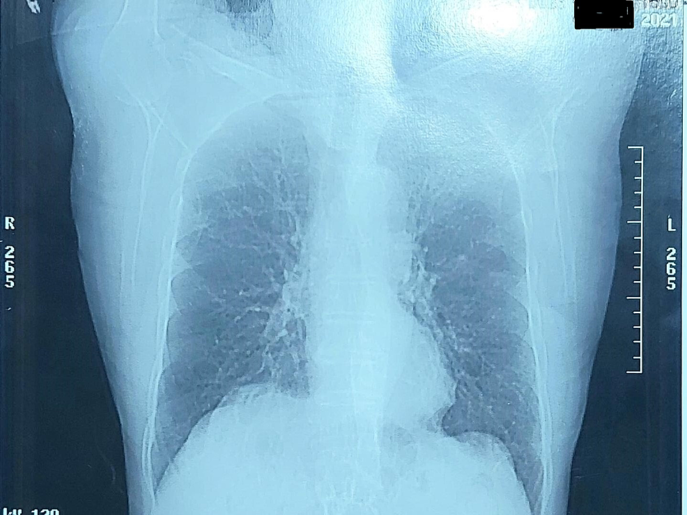 Chest-X-ray-revealed-diffuse-pulmonary-edema,-bilateral-interstitial-infiltrates-and-hazy-opacities