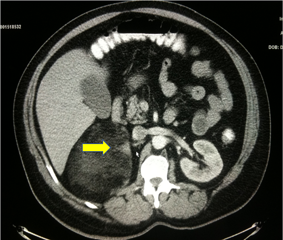 Cureus A Rare Case Of Hemorrhagic Giant Adrenal Myelolipoma Radiographic And Pathologic