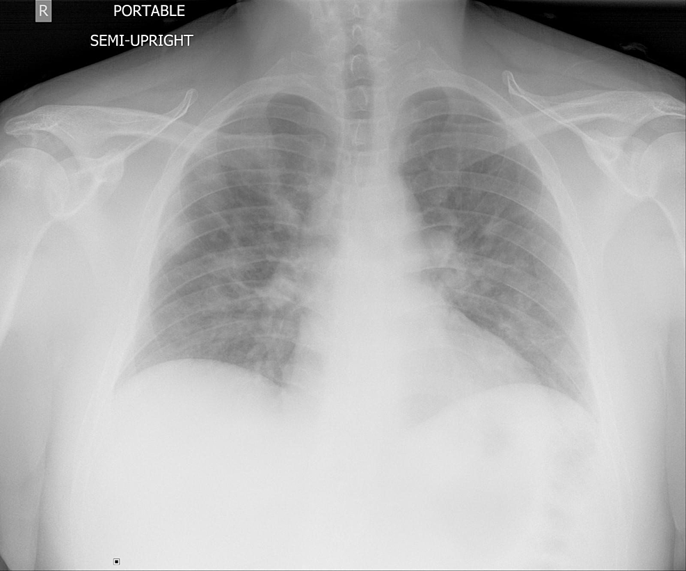 Bilateral-pulmonary-opacities-compatible-with-multifocal-infection-or-edema. 