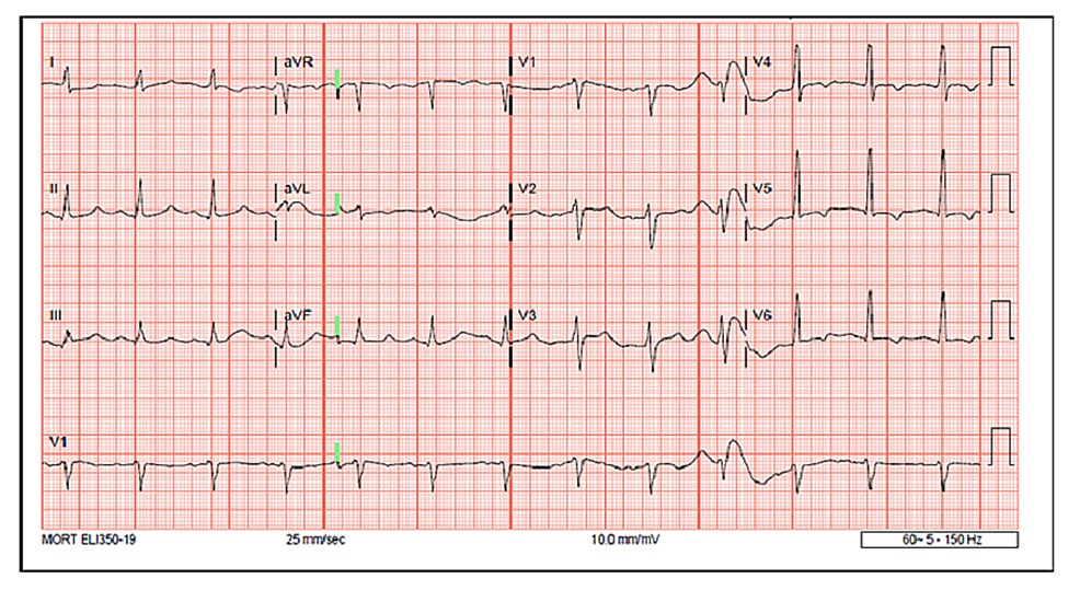 Pseudohyperkalemia and the Need for Imperative Caution With the Newly ...