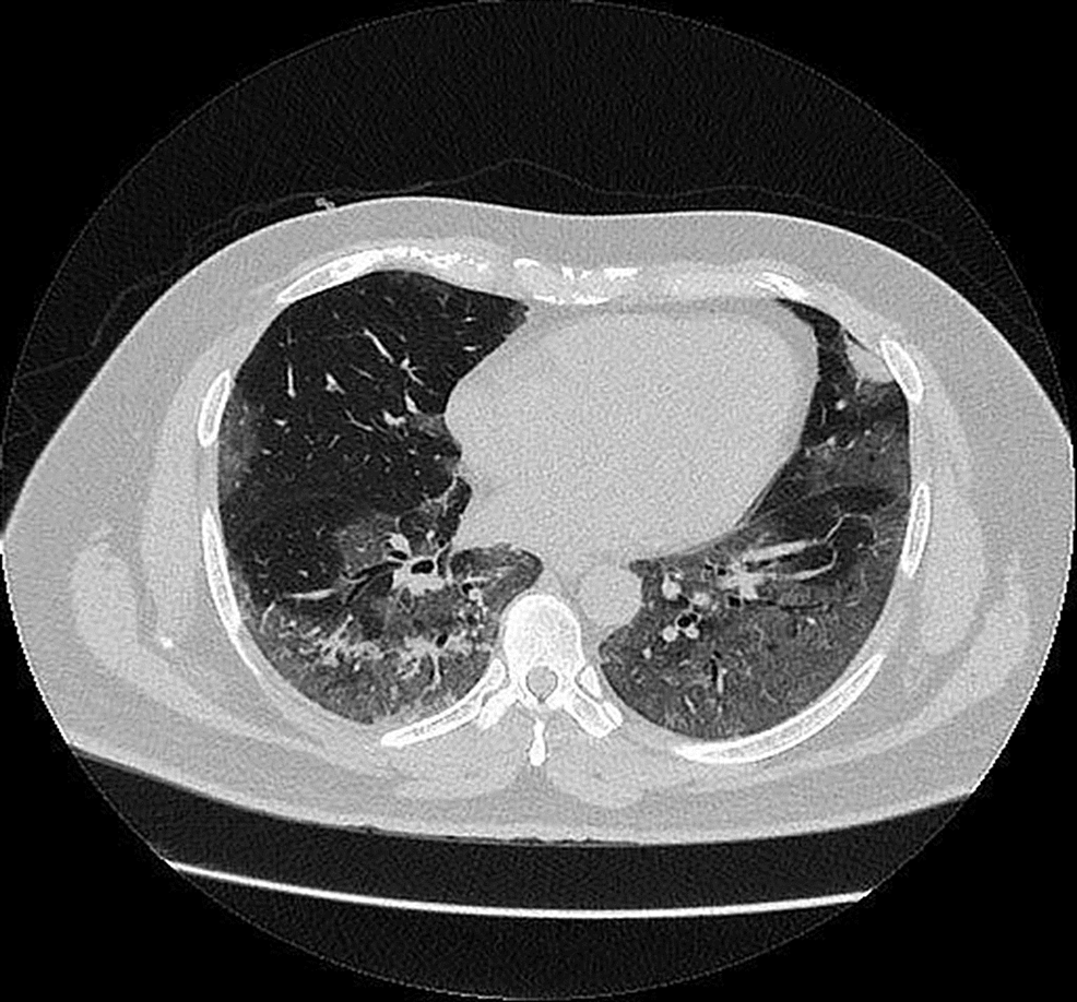 Computed-tomography-(CT)-chest -demonstrated-bilateral-extensive ground-glass opacification at-the-peripheral-lung-zones