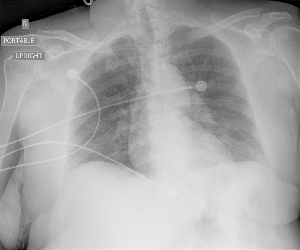 Mild-diffuse-bronchial-wall-thickening-without-focal-consolidation-or-significant-pleural-fluid