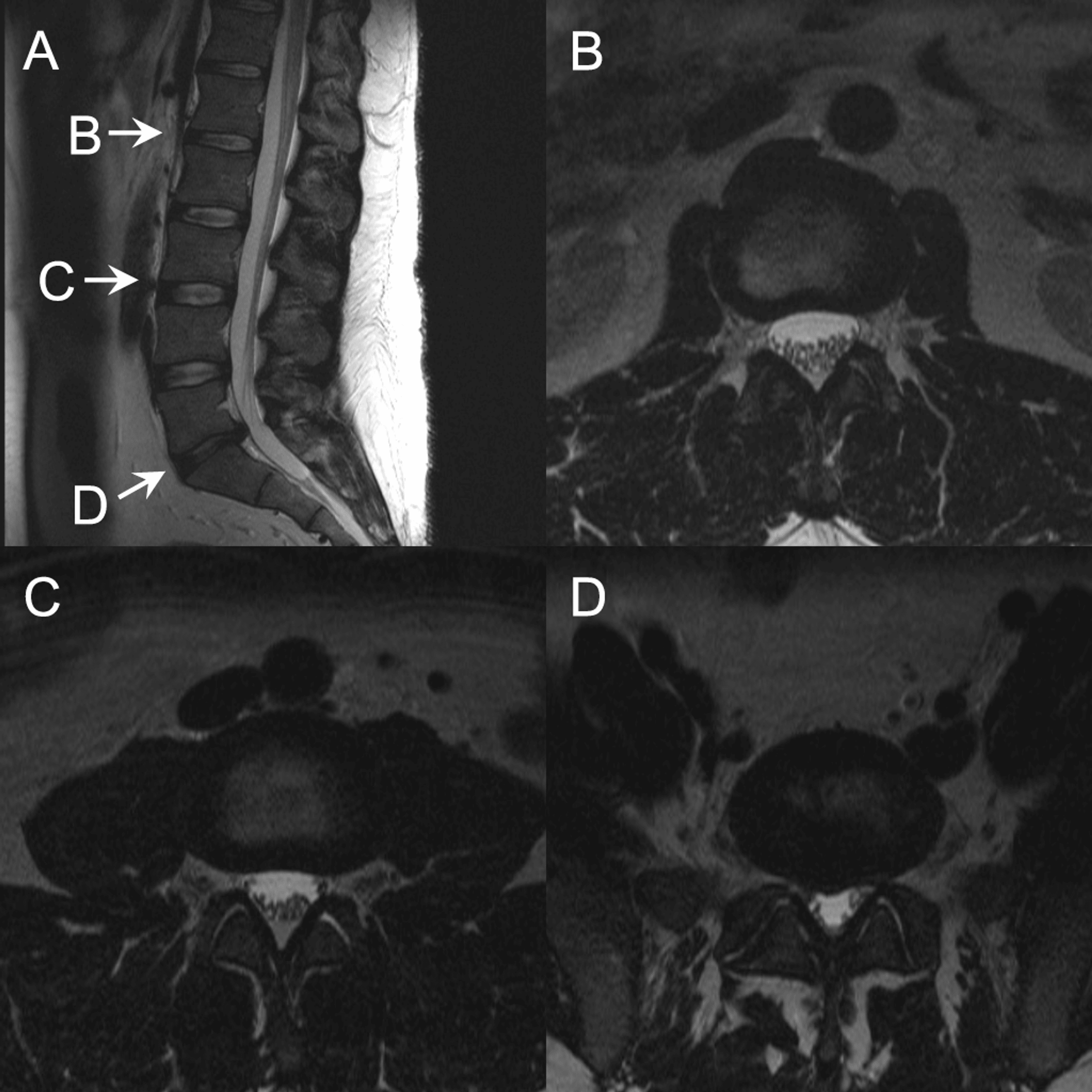 Arachnoiditis Extending Beyond Operative Site Cureus