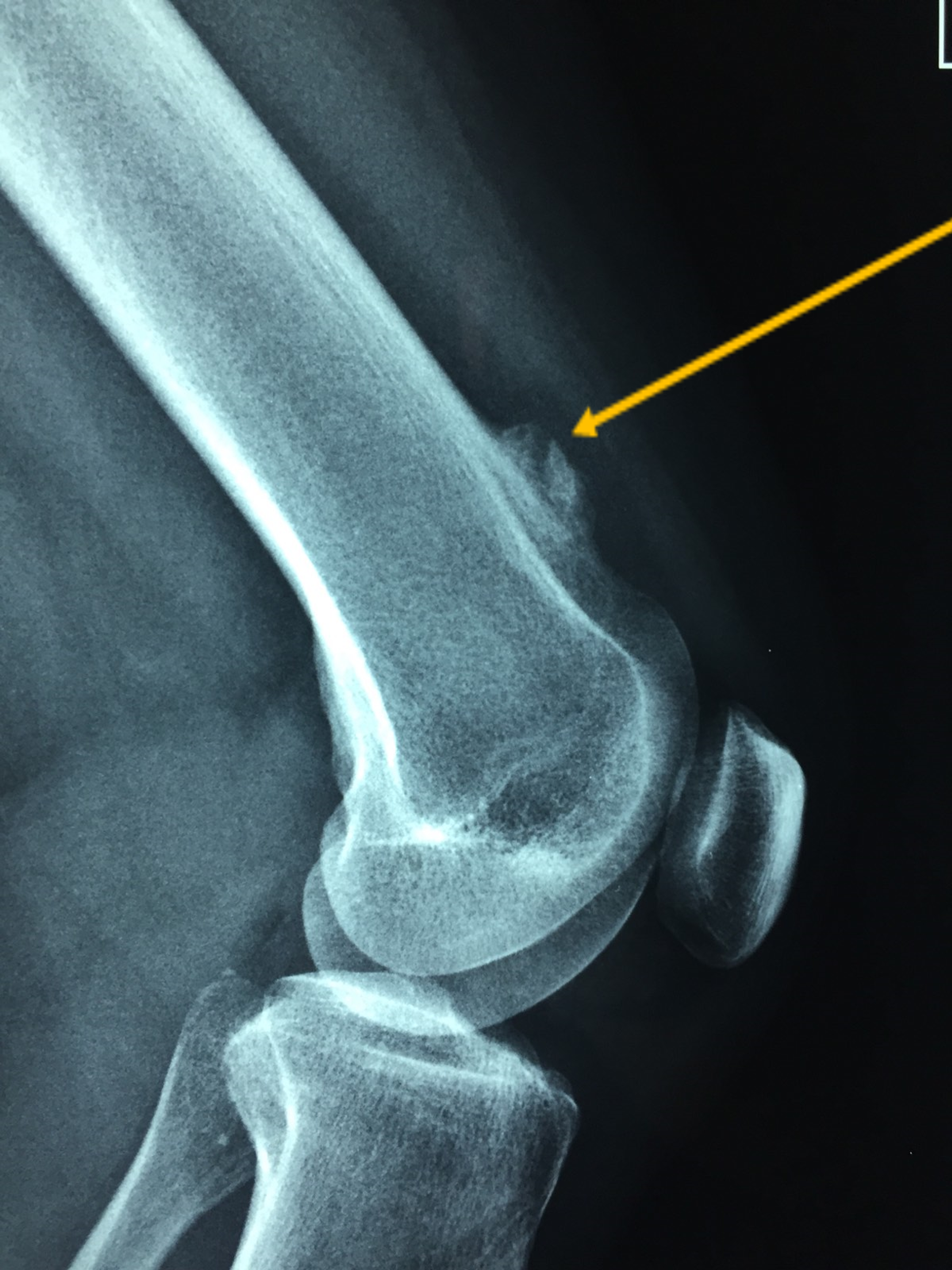 Cureus | Arthroscopic Excision of an Intra-Articular Osteochondroma of the  Knee