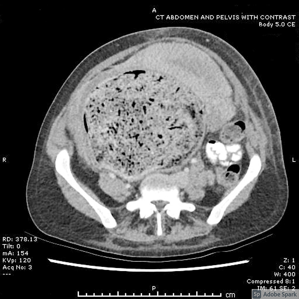 Cureus Acute Pulmonary Edema in Pregnancy Fluid Overload or