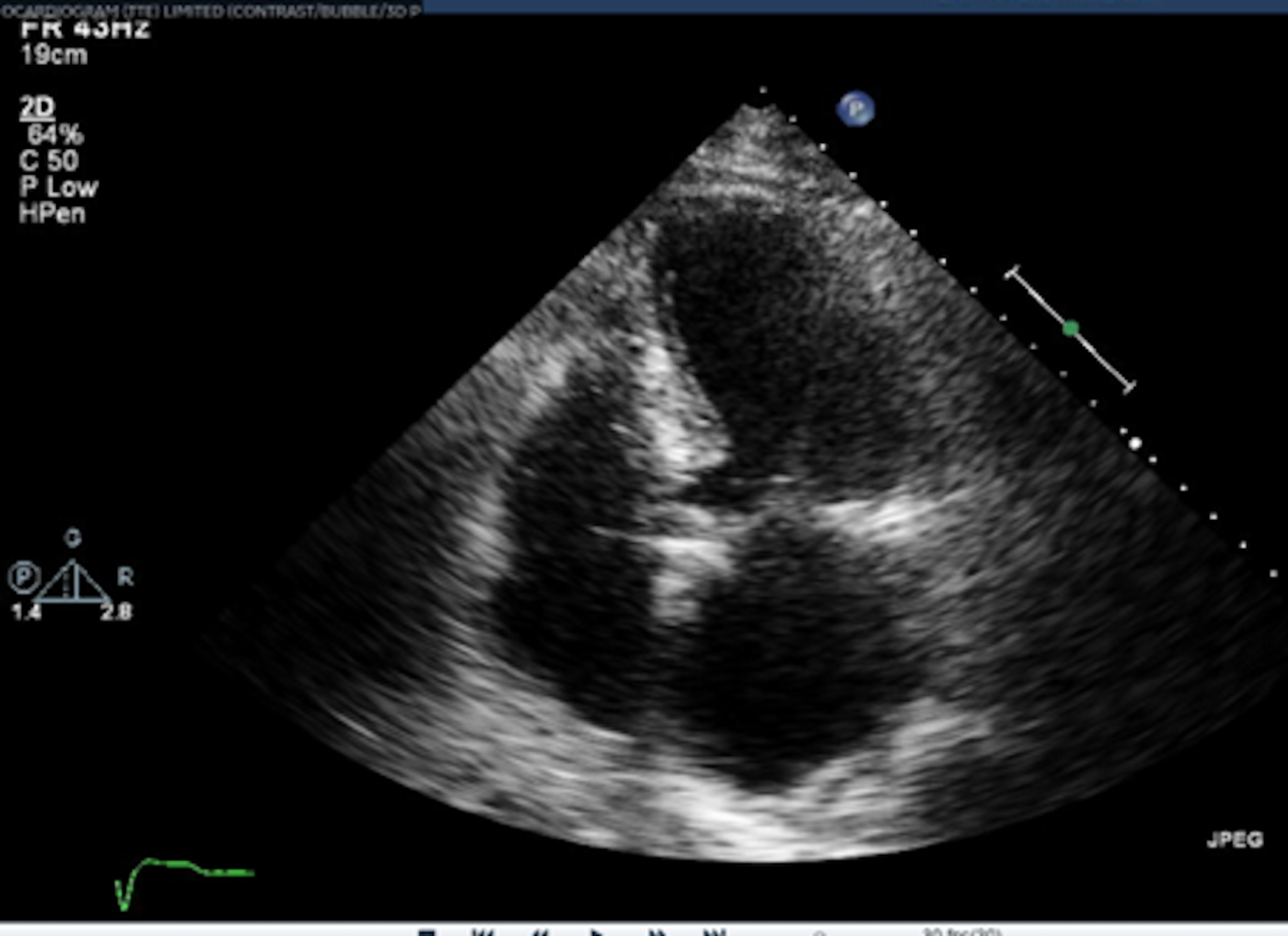 Cureus | Submassive Pulmonary Embolism Complicating Small Bowel Obstruction