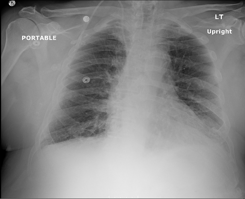 Acute Eosinophilic Pneumonia Secondary to Daptomycin | Cureus