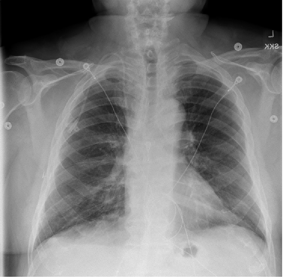 Cureus | Acute Eosinophilic Pneumonia Secondary to Daptomycin