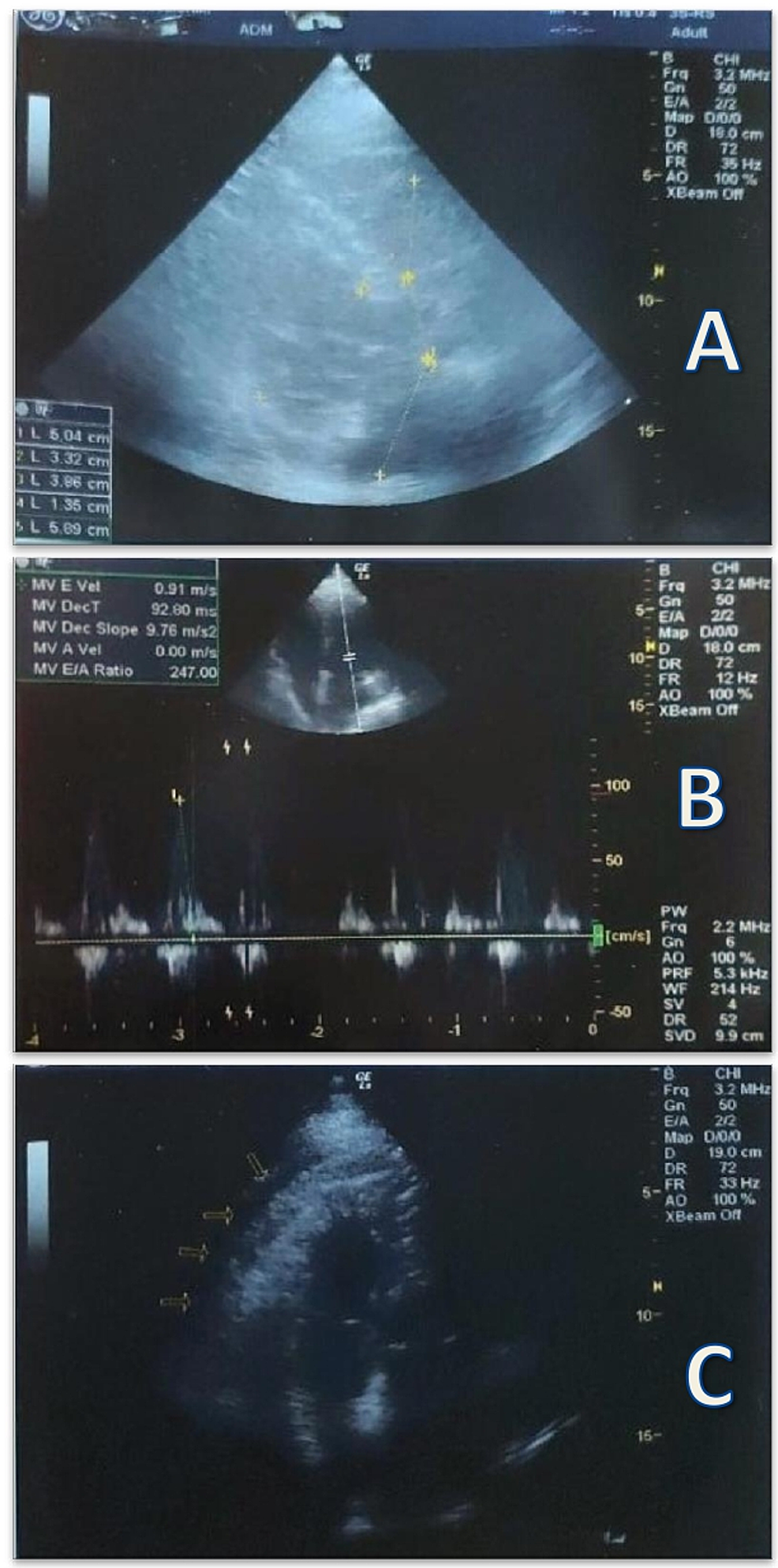 Echocardiography-revealed-an-LV-ejection-fraction--of-50%-55%-with-grade-III-left-ventricular-diastolic-dysfunction,-biatrial-and-biventricular-dilatation,-a-mild-pericardial-effusion,-and-a-moderate-septal-hypertrophy