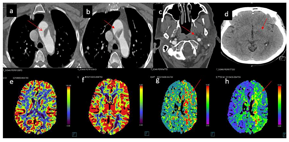 Cureus | Acute Thromboembolic Ischemic Stroke From Complex Aortic Arch ...