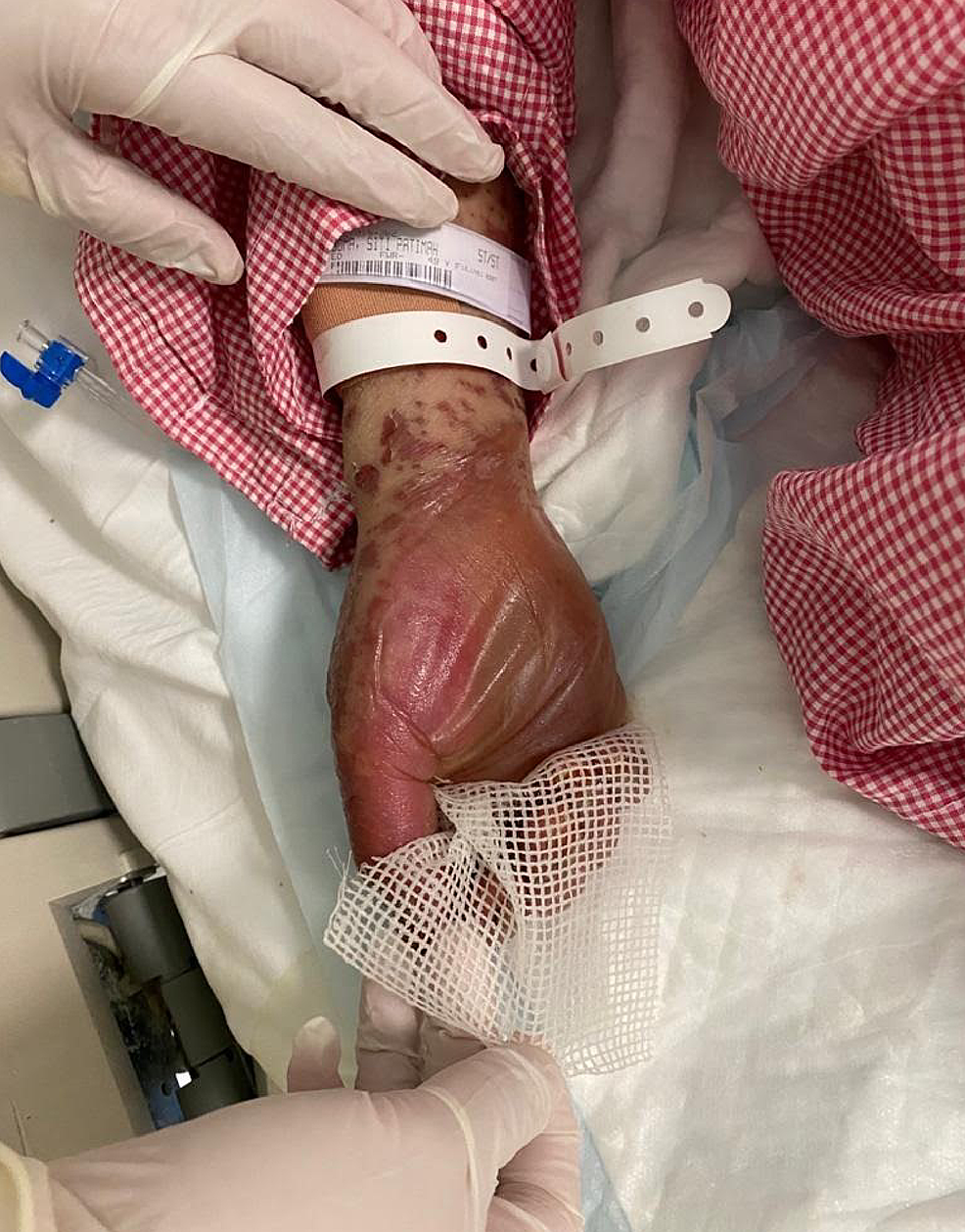 Overall-image-of-the-hand-before-initiating-the-treatment Overall-image-of-the-hand-before-initiating-the-treatment