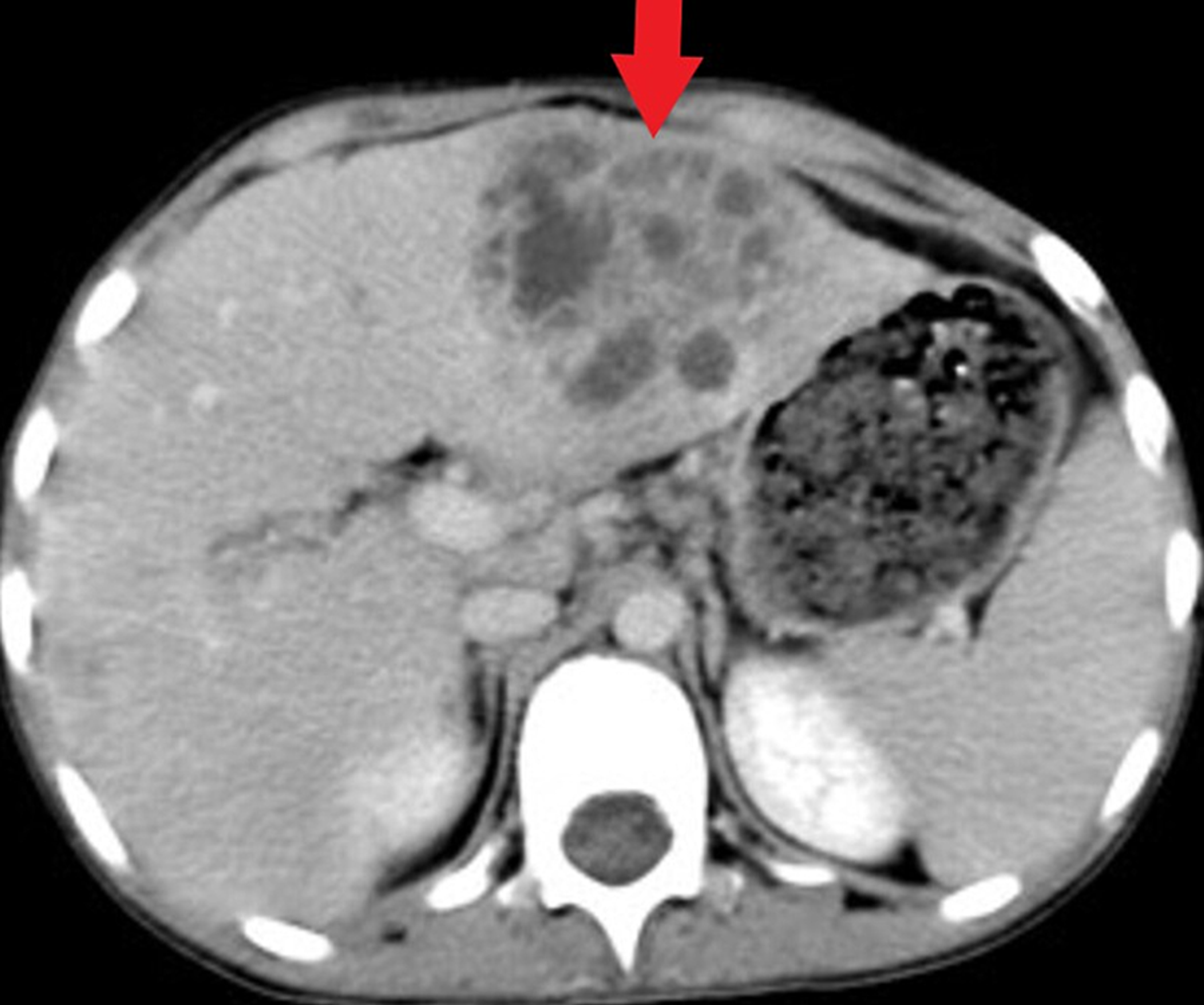 Cureus Liver Abscesses as a Sign of Chronic Granulomatous Disease in