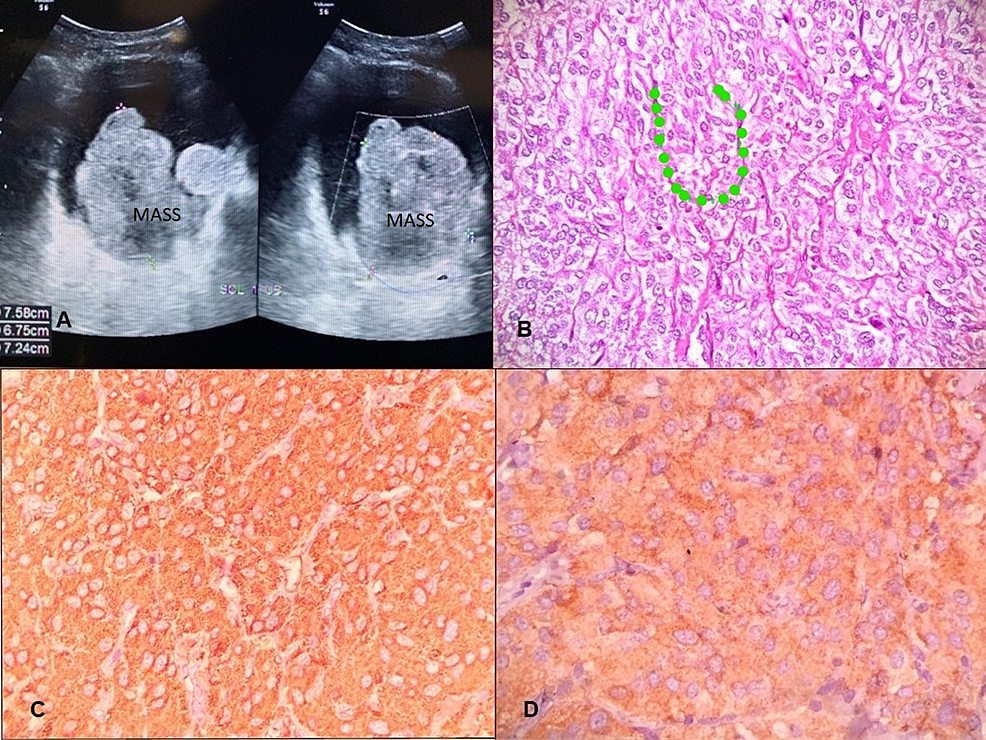 Cureus Paraganglioma Of Urinary Bladder An Uncommon Entity In Uropathology 8809