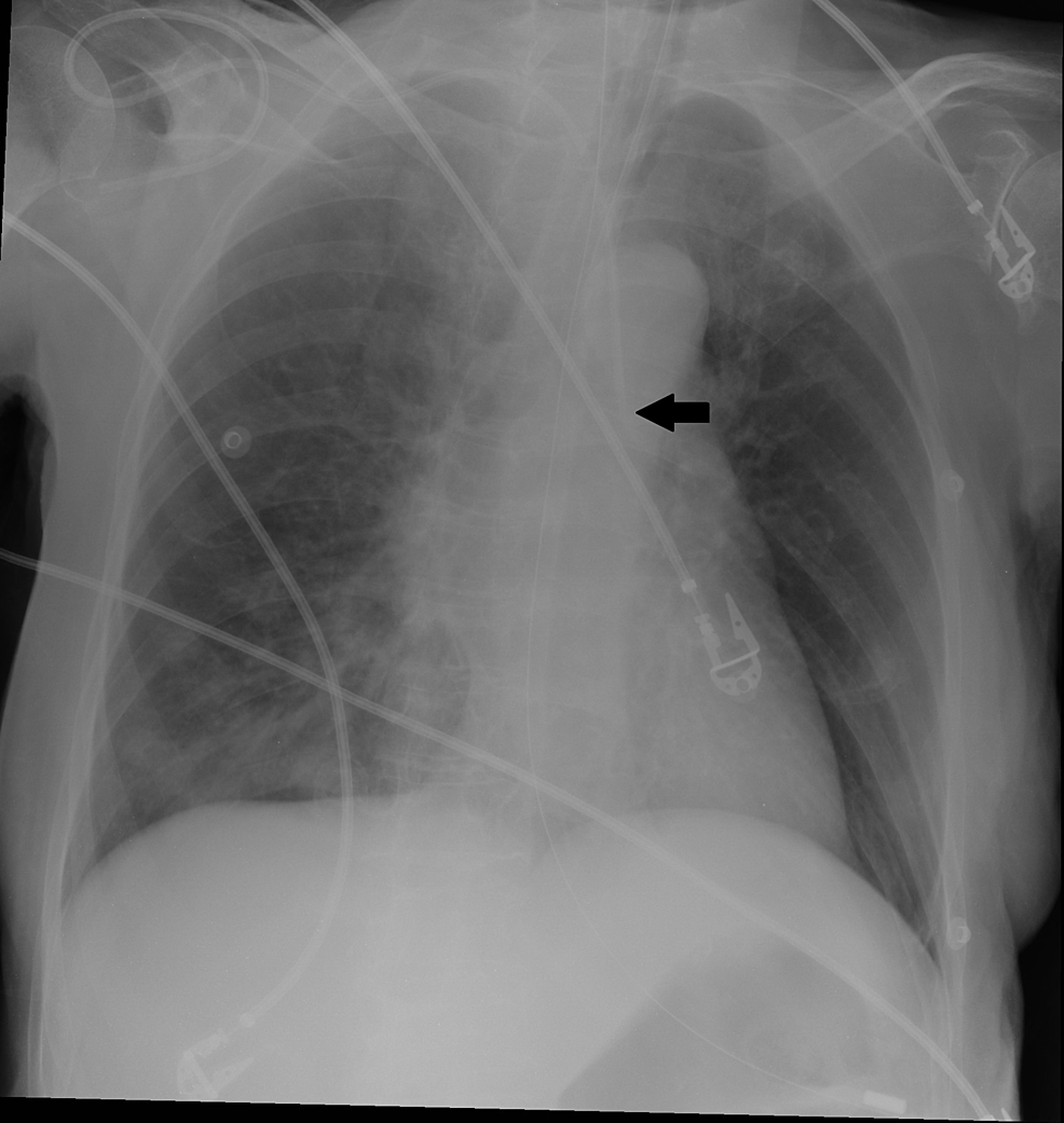 Inadvertent Arterial Cannulation and Norepinephrine Infusion Due to a ...