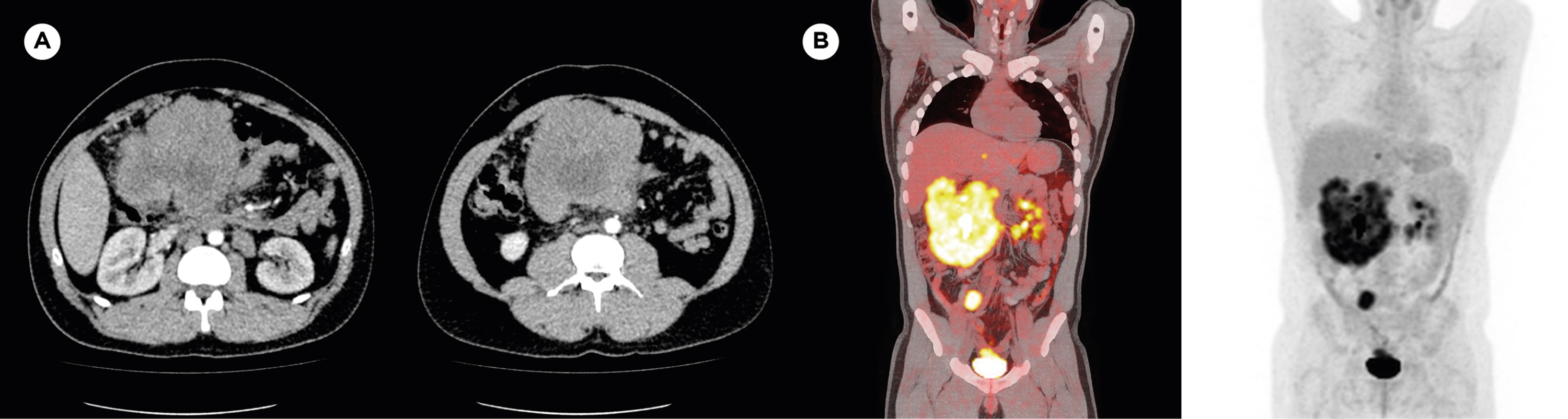 What Stage Is Infiltrating Ductal Carcinoma