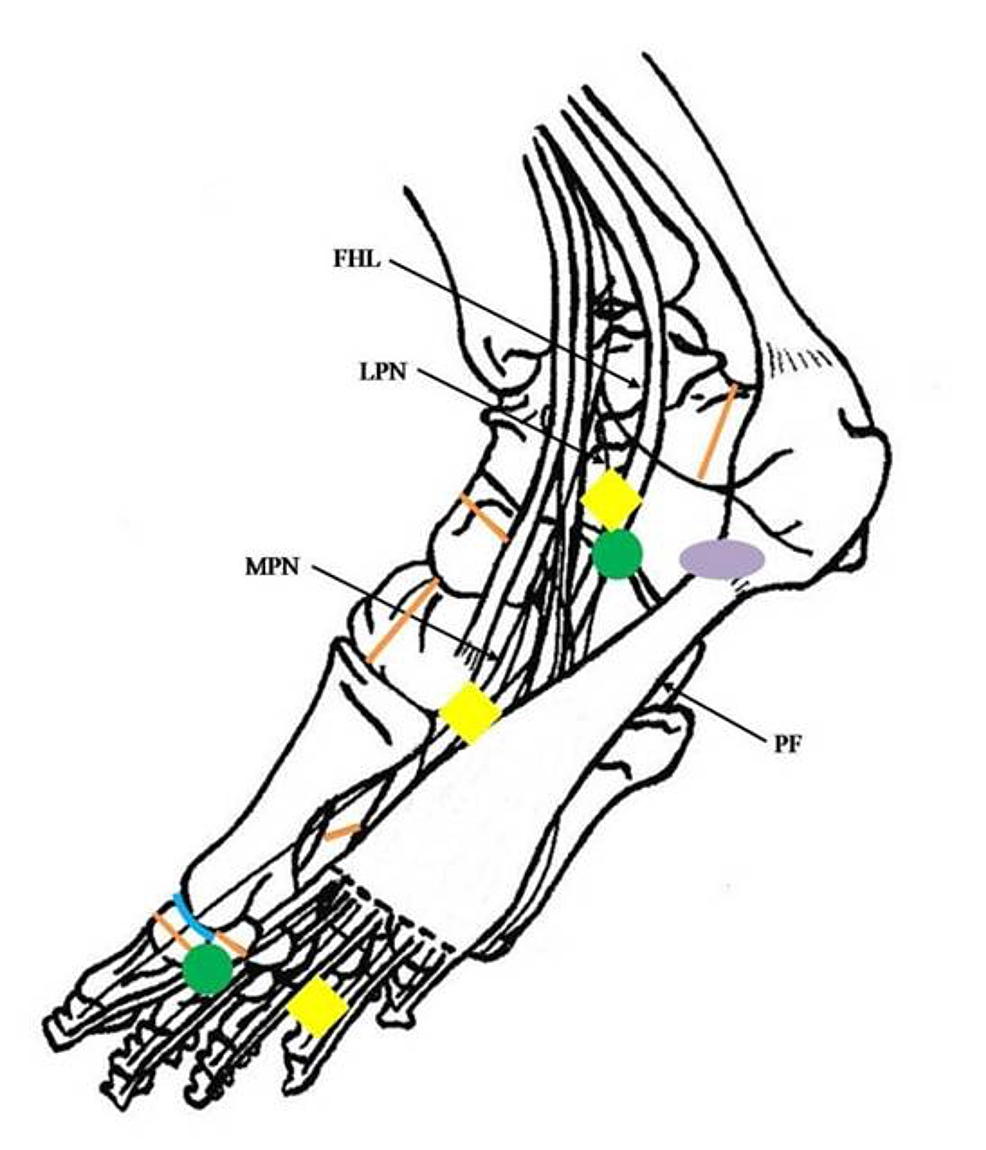 Cureus Plantar Injuries in Runners Is There an Association With Weekly Running Volume? Article