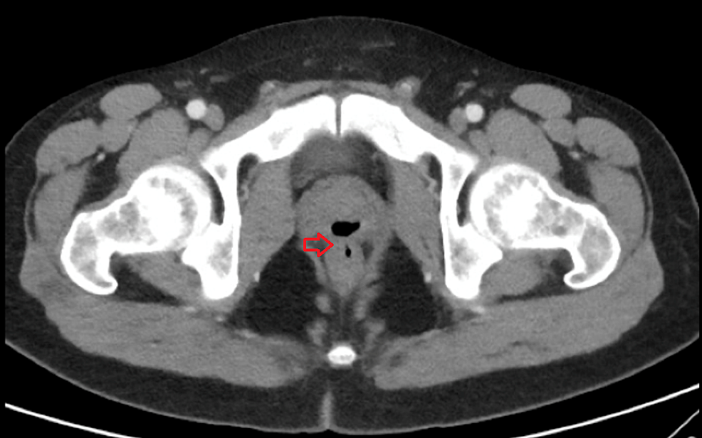 CT-demonstrating-gas-filled-structure-within-the-posterior-aspect-of-the-prostate-communicating-with-the-adjacent-rectum.