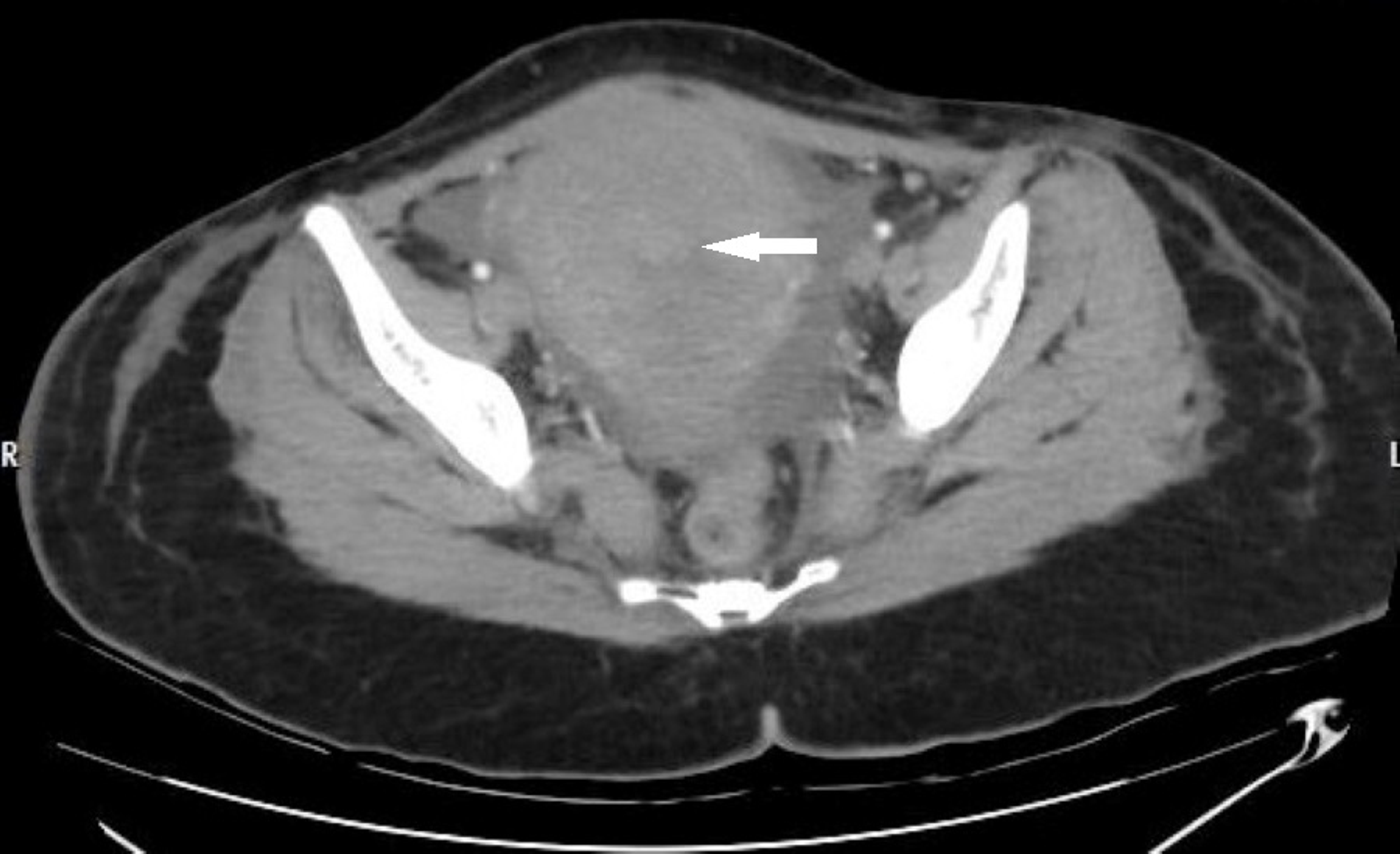 Cureus Intestinal Perforation Secondary to Mucormycosis Associated