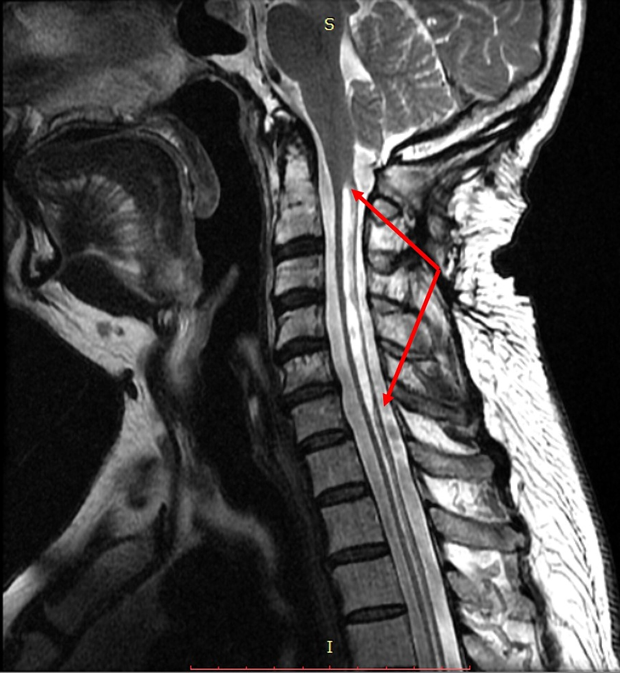 Syringomyelia - Pictures