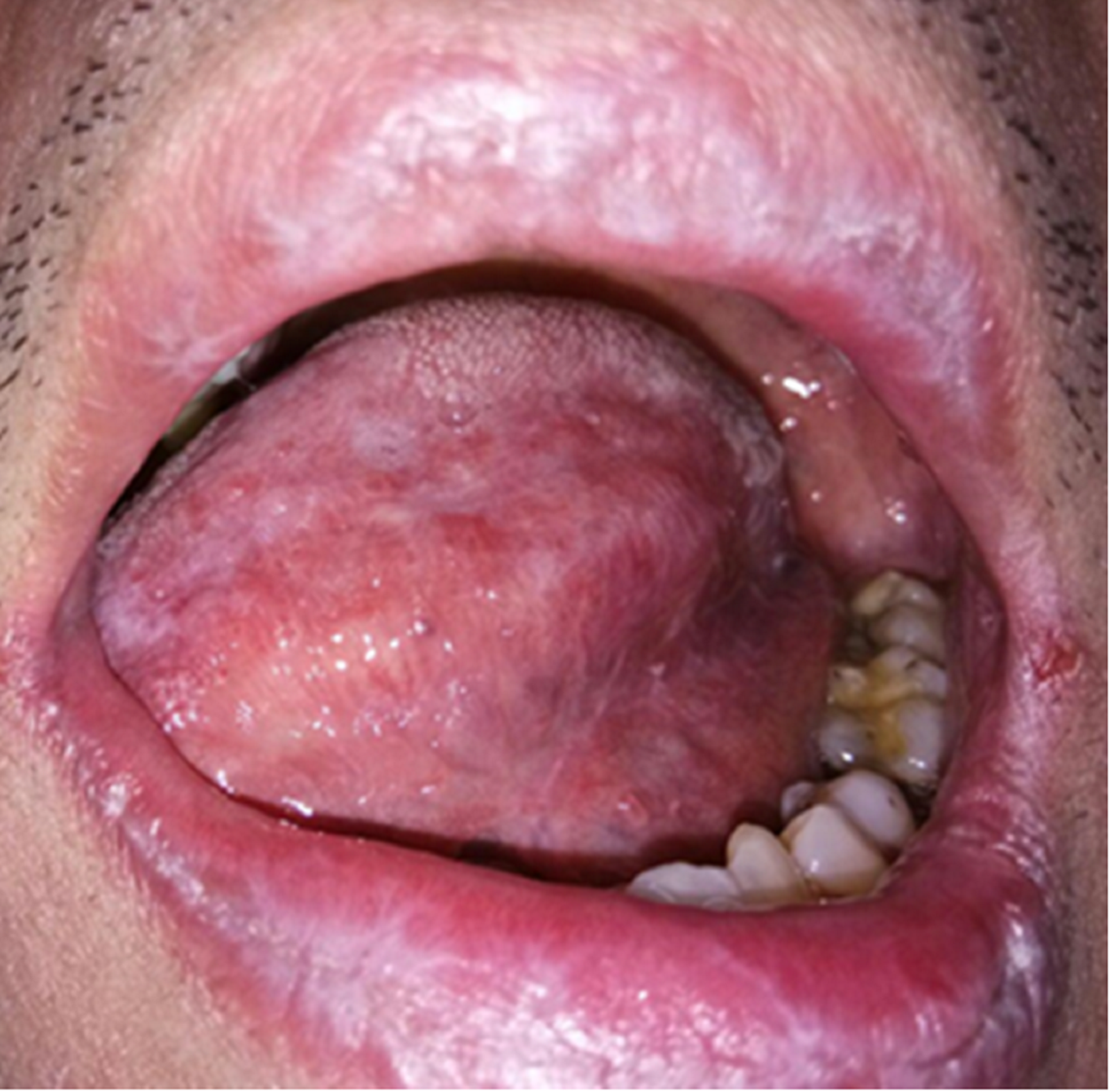 lichen planus mouth lesions